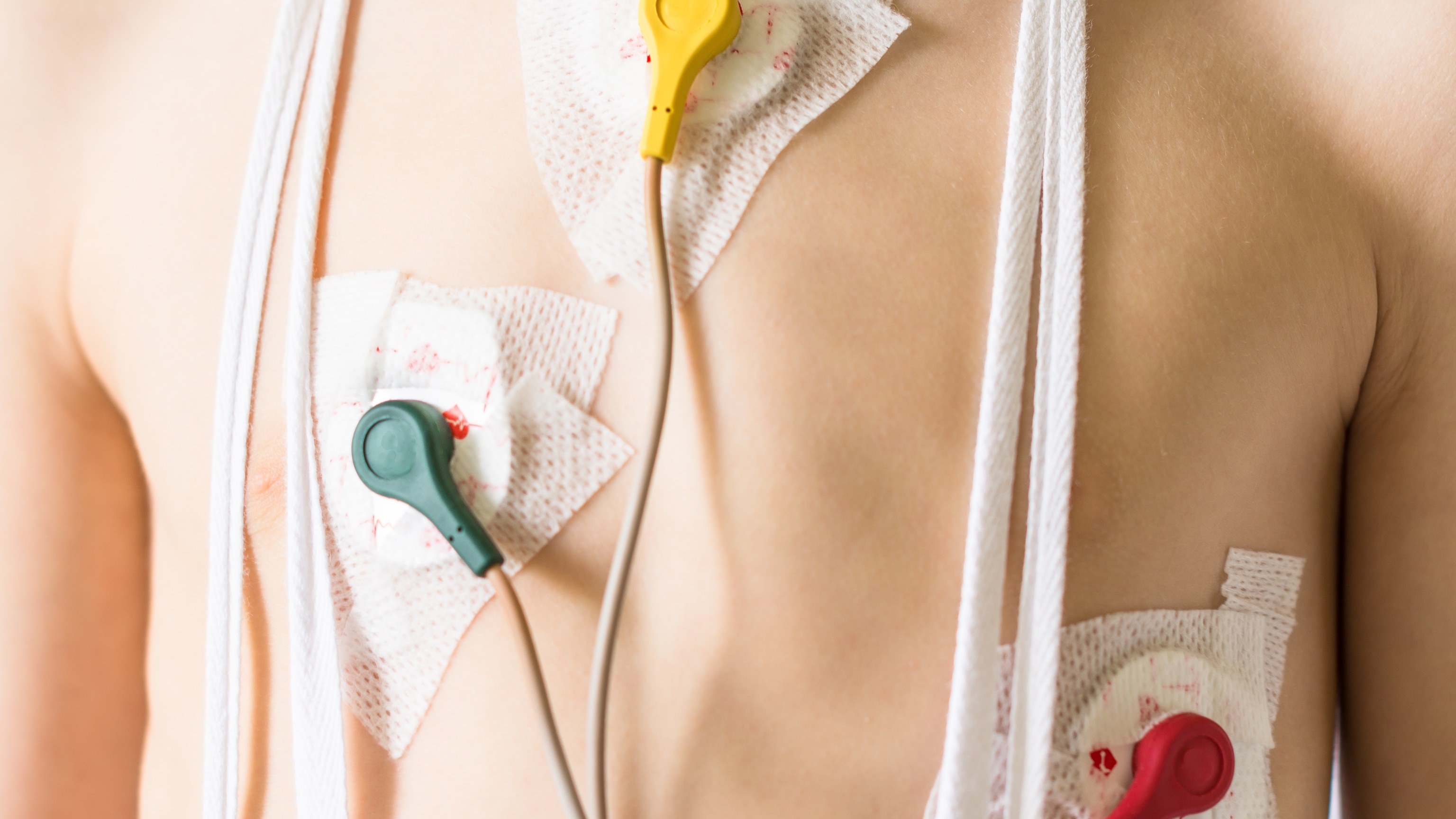 How Heart Disease Can Start as Early as Your 20s