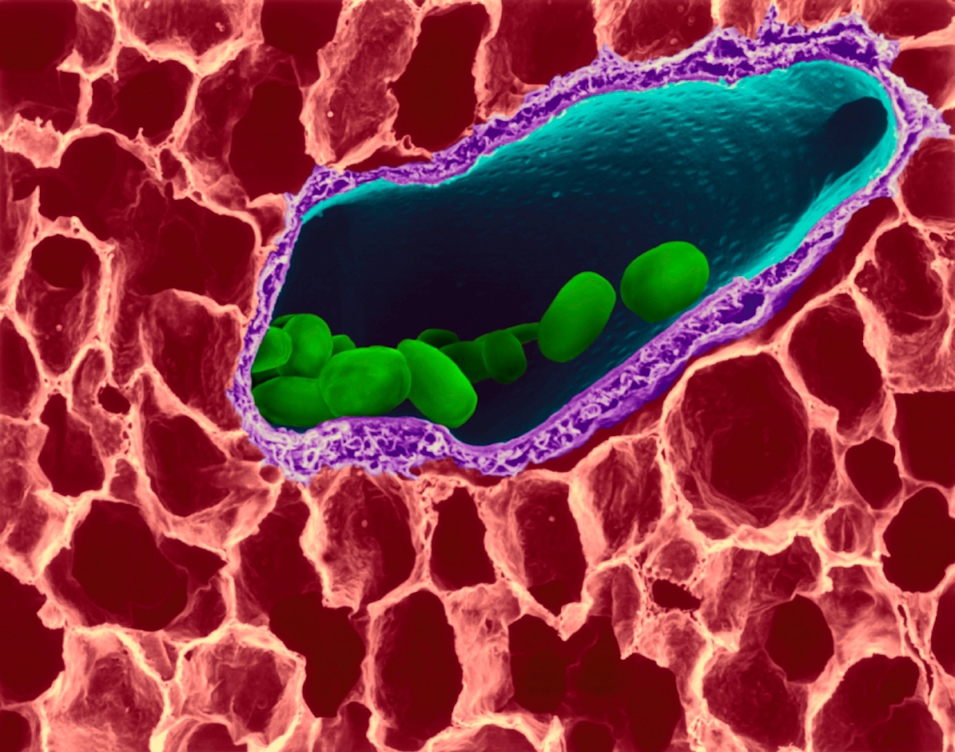 Anthrax picture - Bacillus anthracis spores in lung