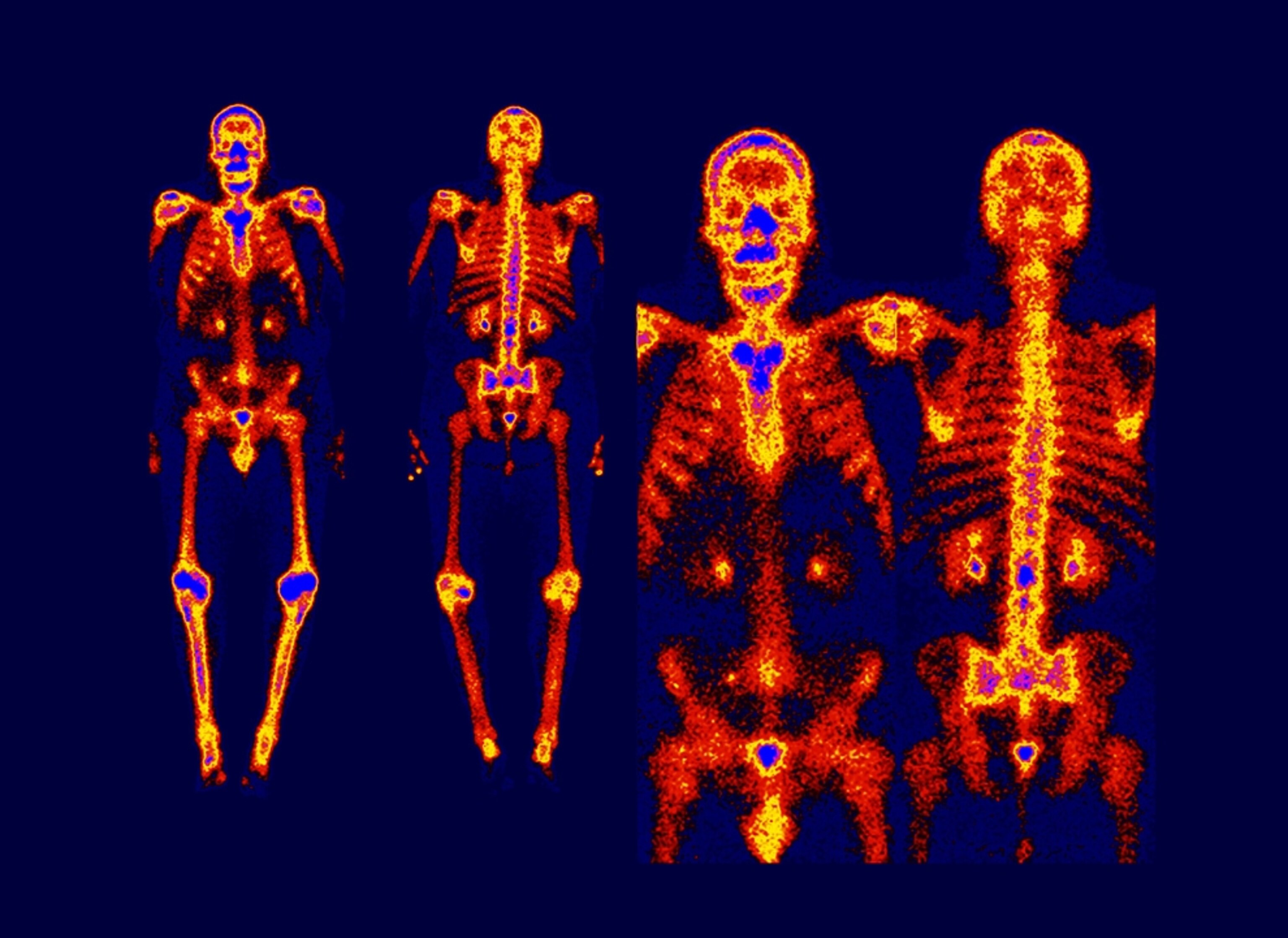 nuclear imaging on a human body to detect fractures or cancer