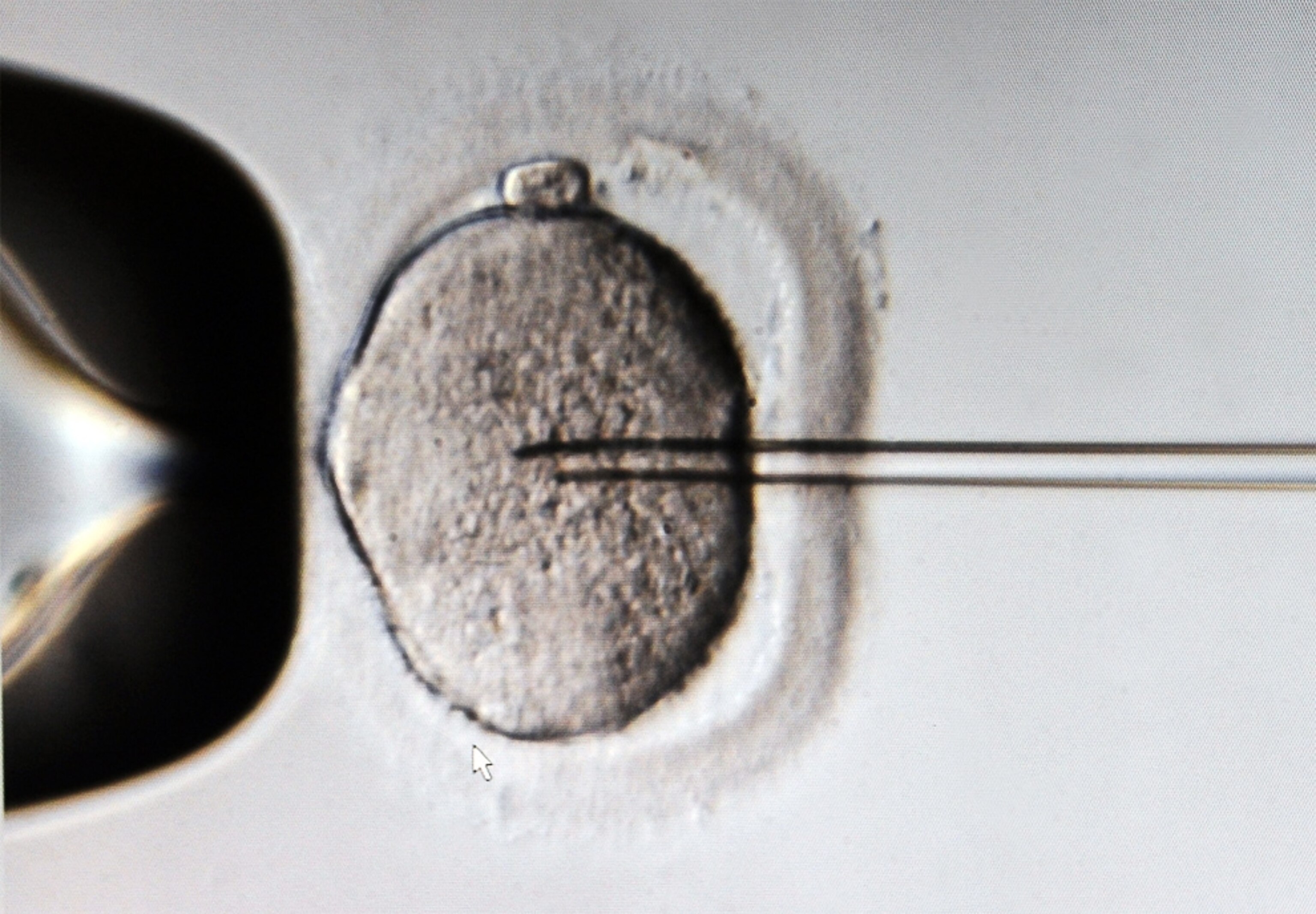 sperm being injected into a human egg during an in vitro fertilization procedure