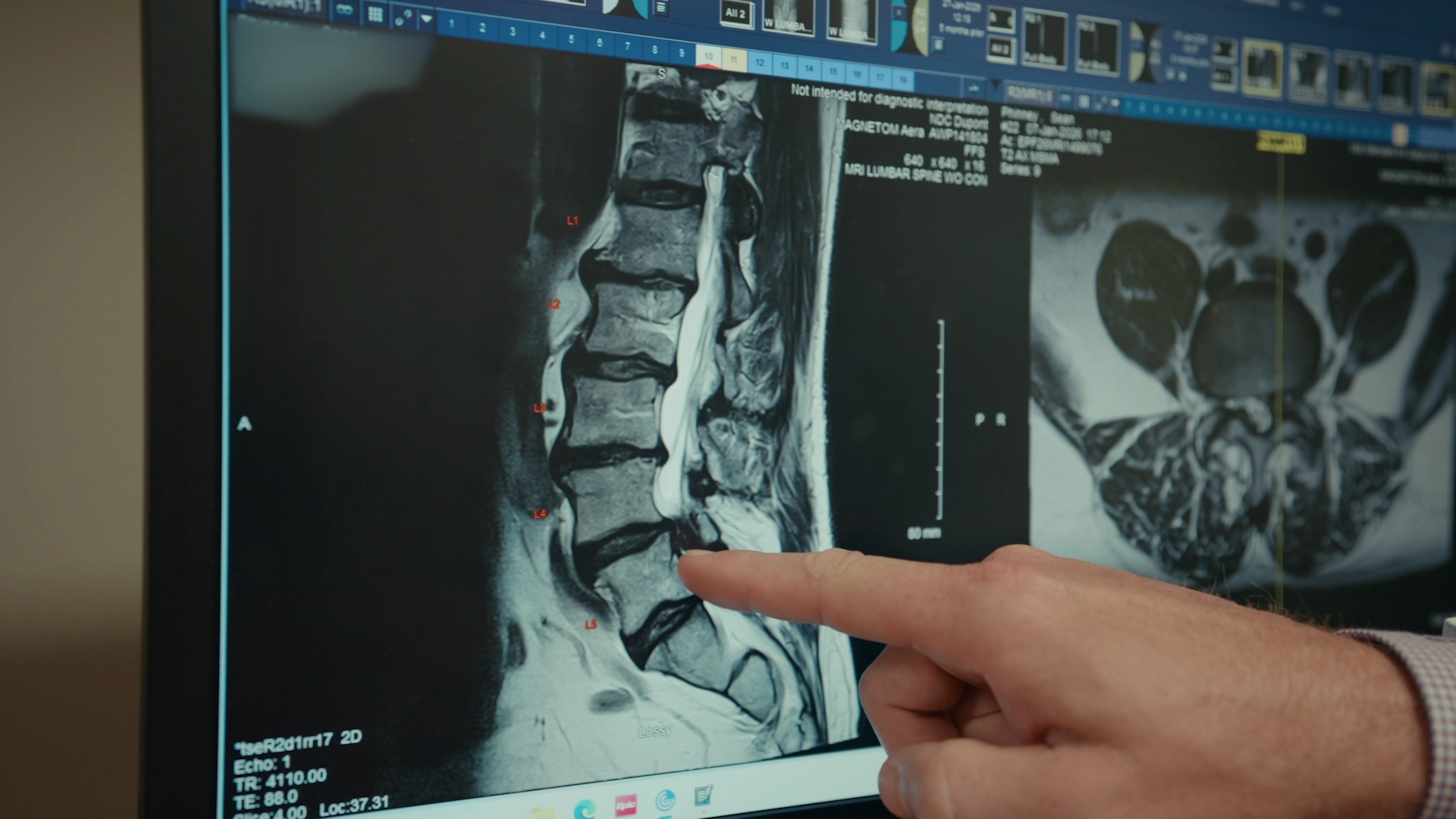 Closing the Loop on Spinal Surgery