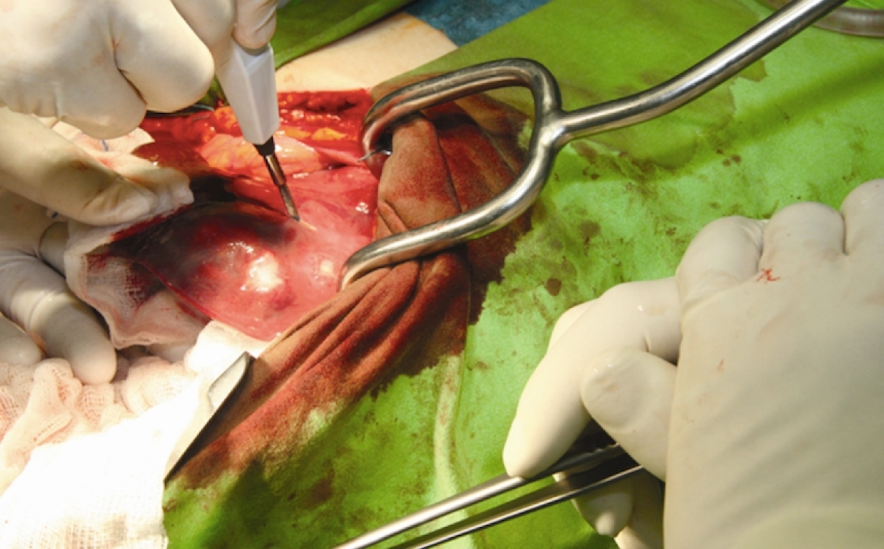 The iKnife in action. Image courtesy of Science Translational Medicine/AAAS.