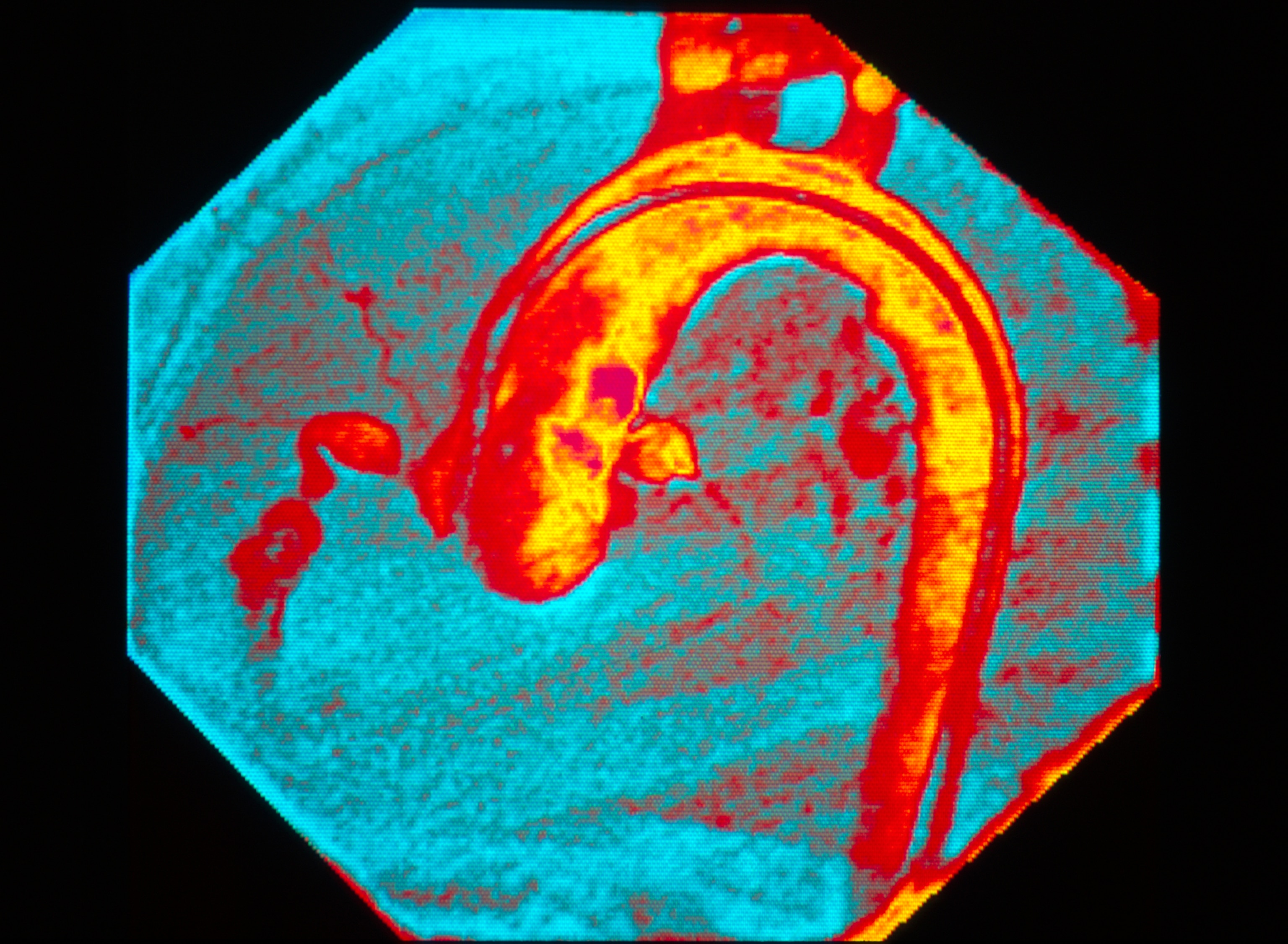 Kawasaki disease. Coloured angiogram (X-ray) of abnormal coronary arteries in a child suffering from Kawasaki disease.