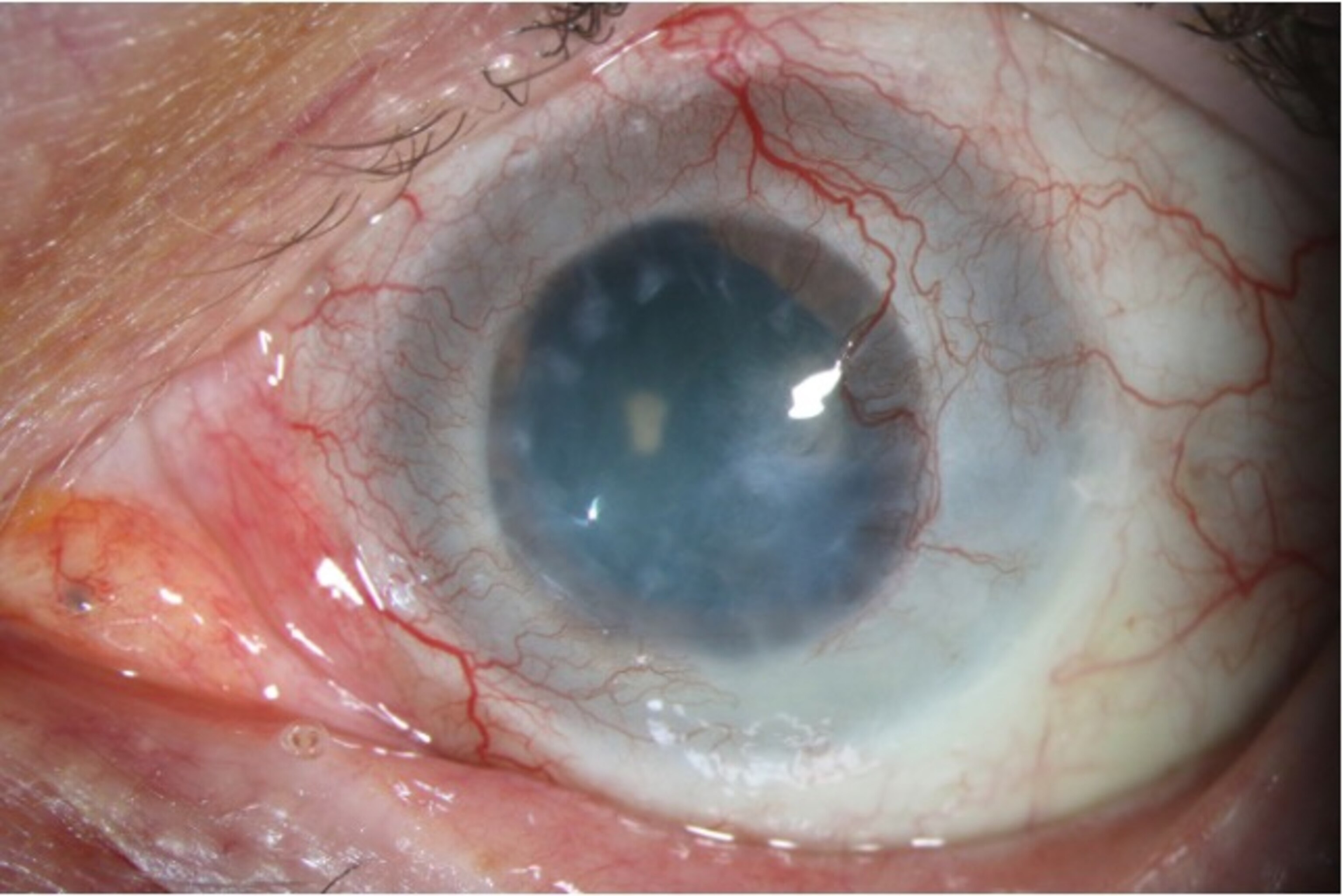 A close-up of a human eye with a cloudy cornea