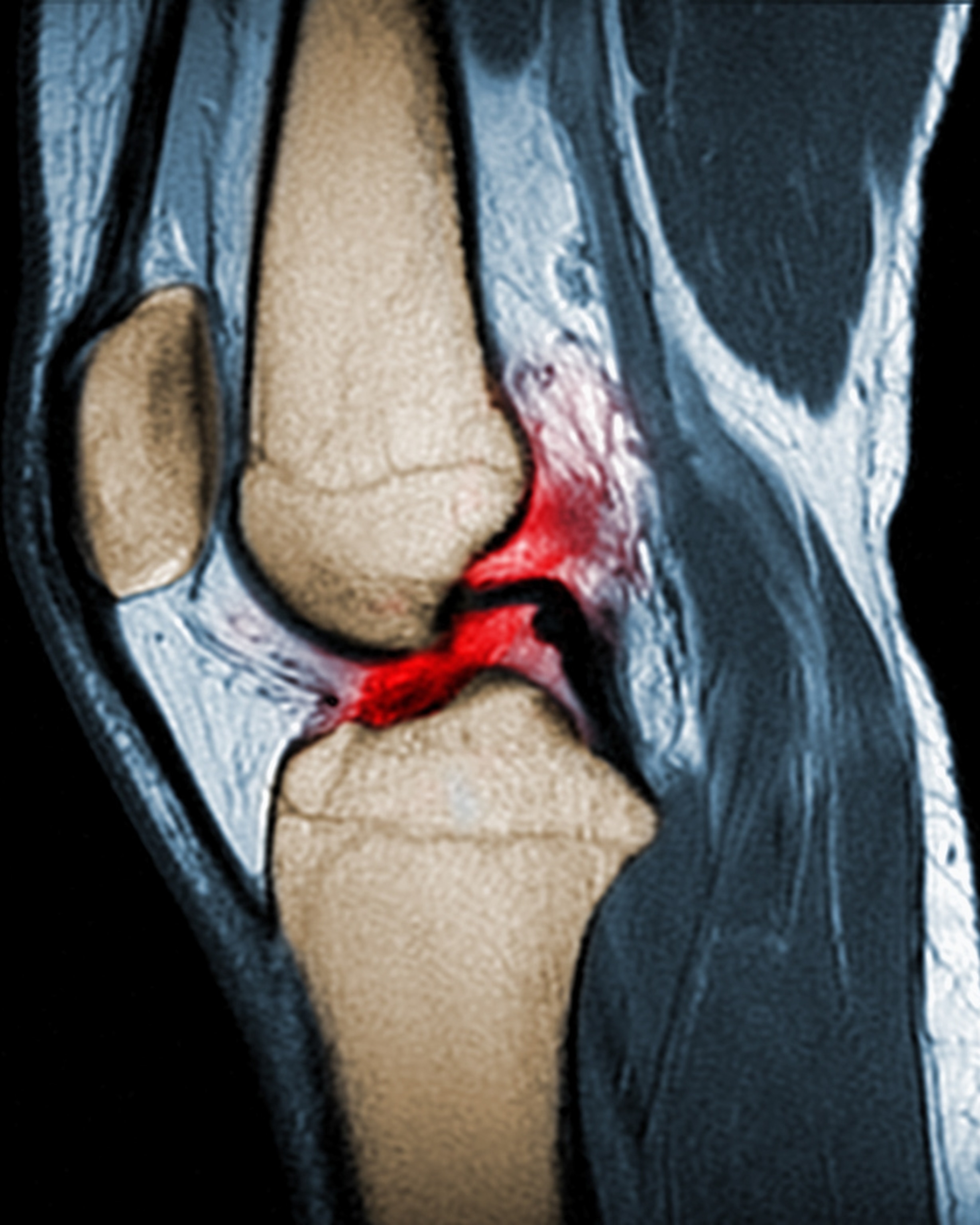A colorized lateral MRI view of a knee joint with a torn ligament colored red.