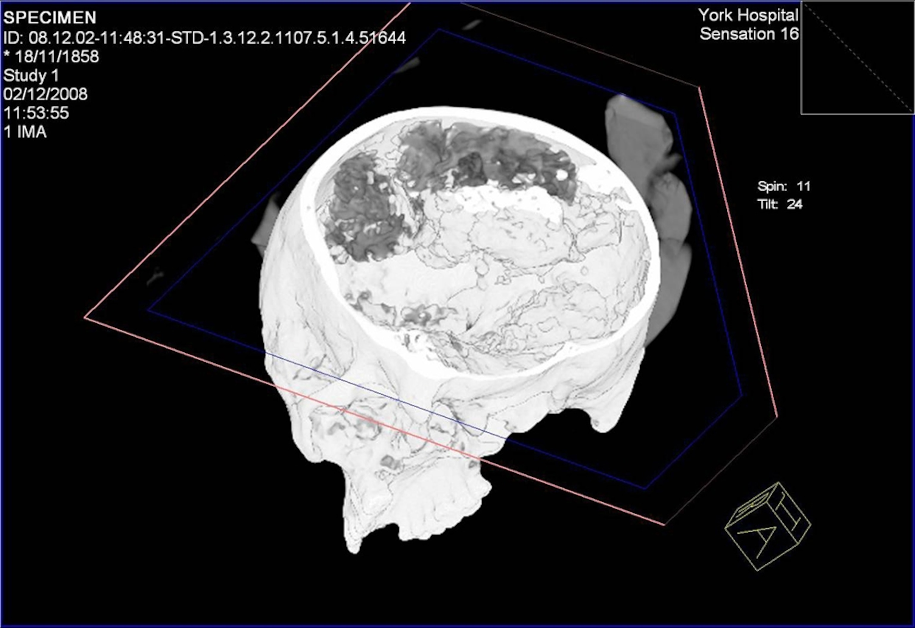 A computer-generated scan of Britain's oldest brain