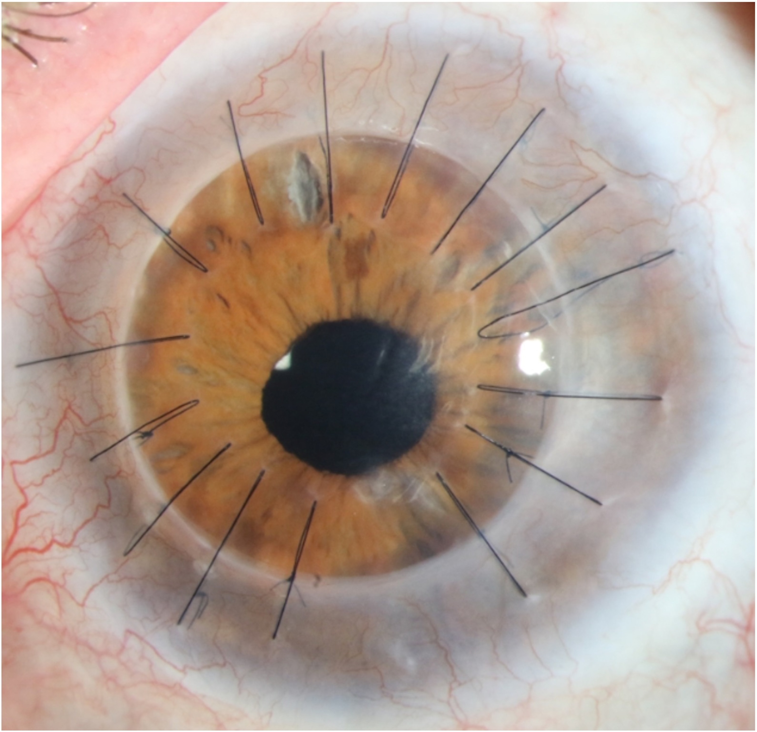 A close-up of a human eye with 15 stitches through the cornea