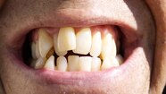 Humans Used To Have Straighter Teeth what Changed National Geographic