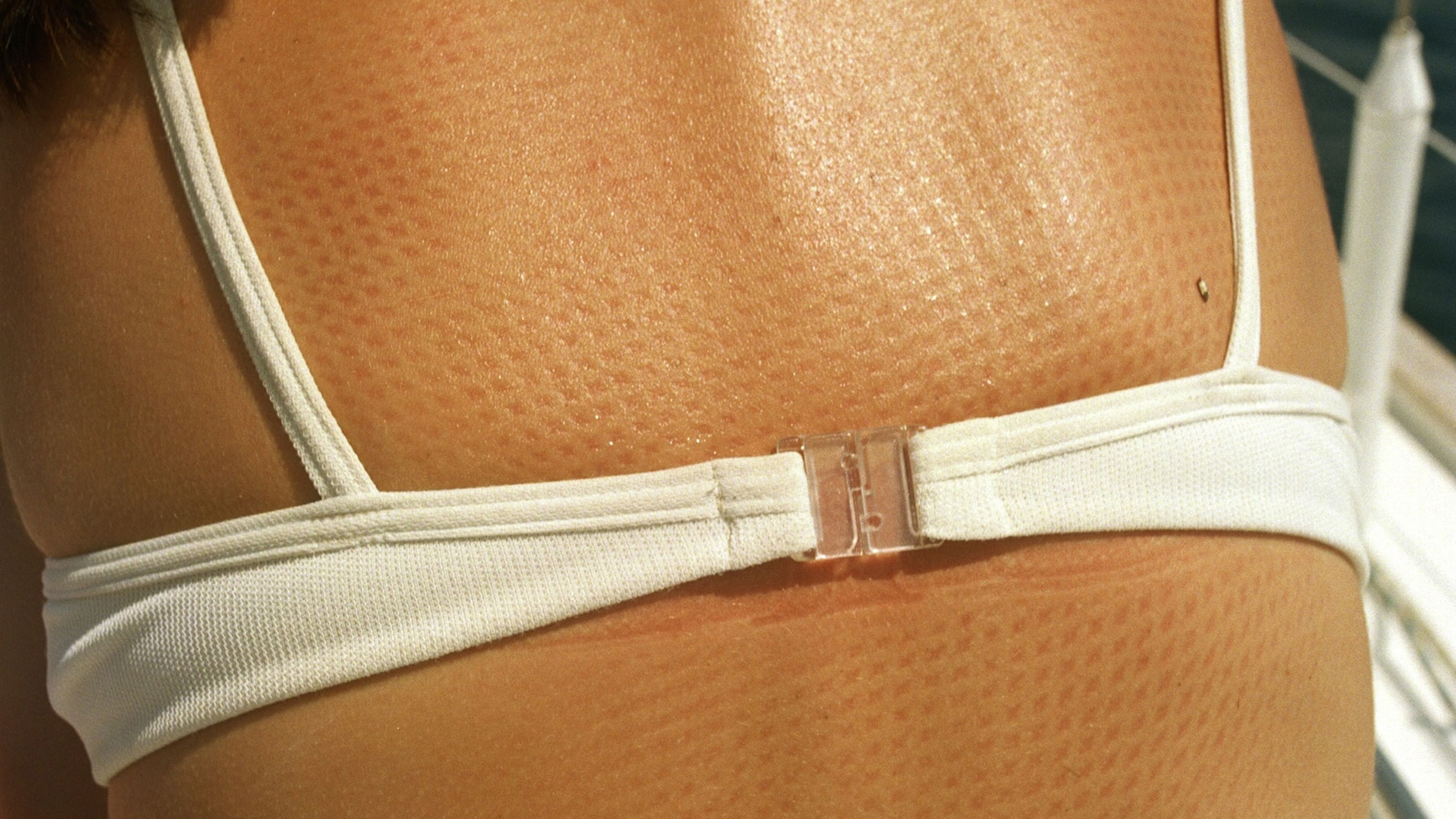 How a warming planet is wreaking havoc on your skin