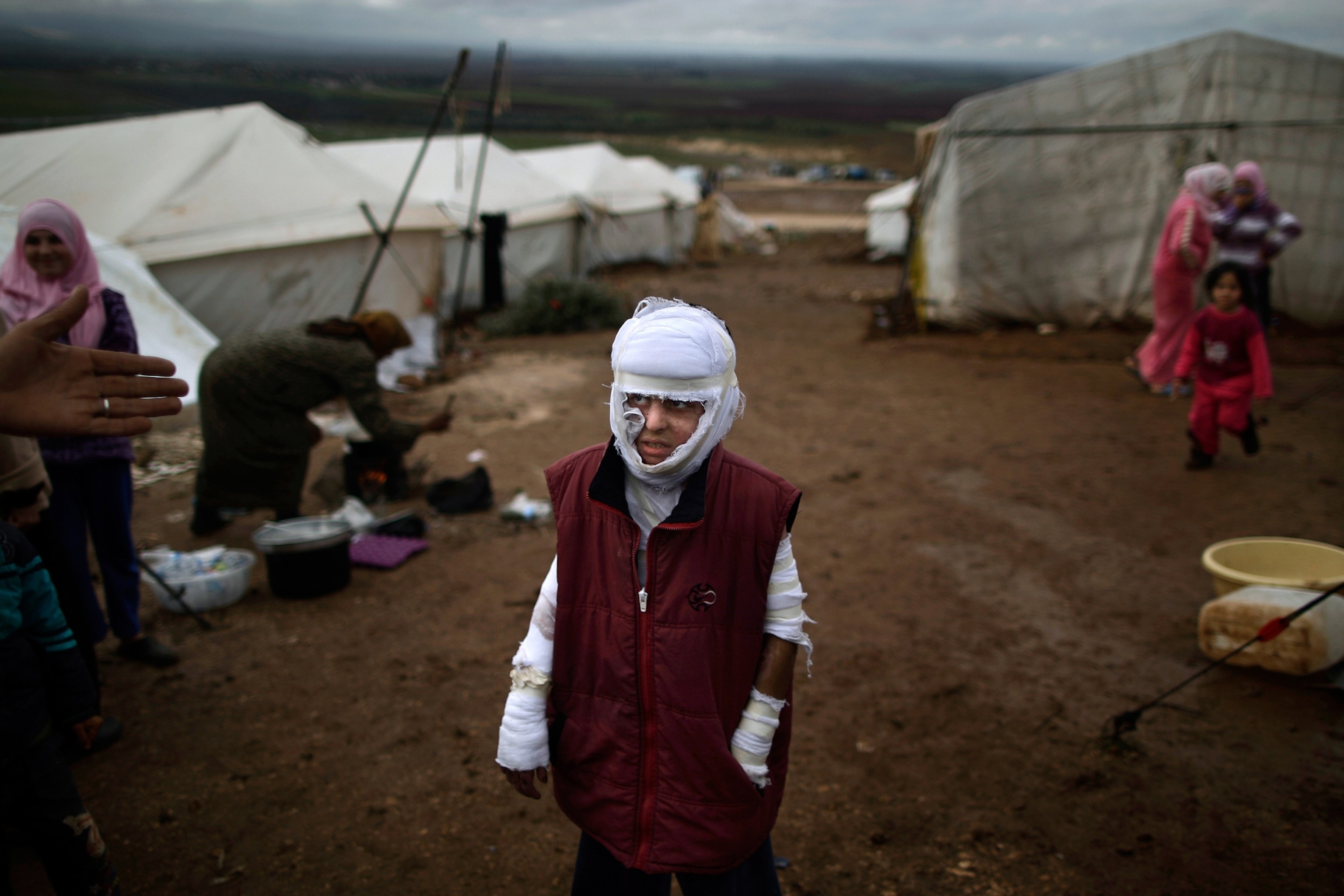a young, displaced Syrian boy with burn wounds wrapped in cloth