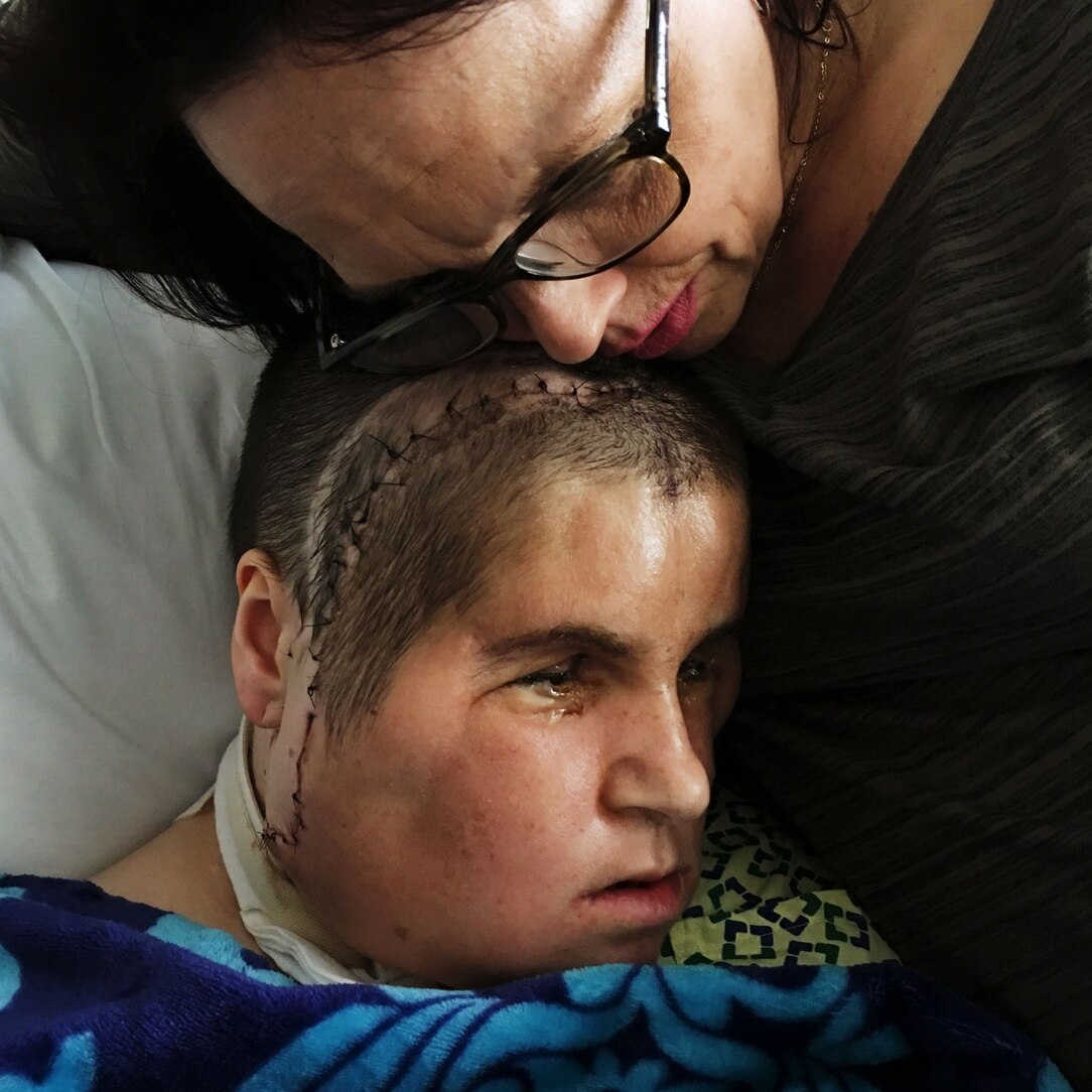 Grzegorz Face Transplant