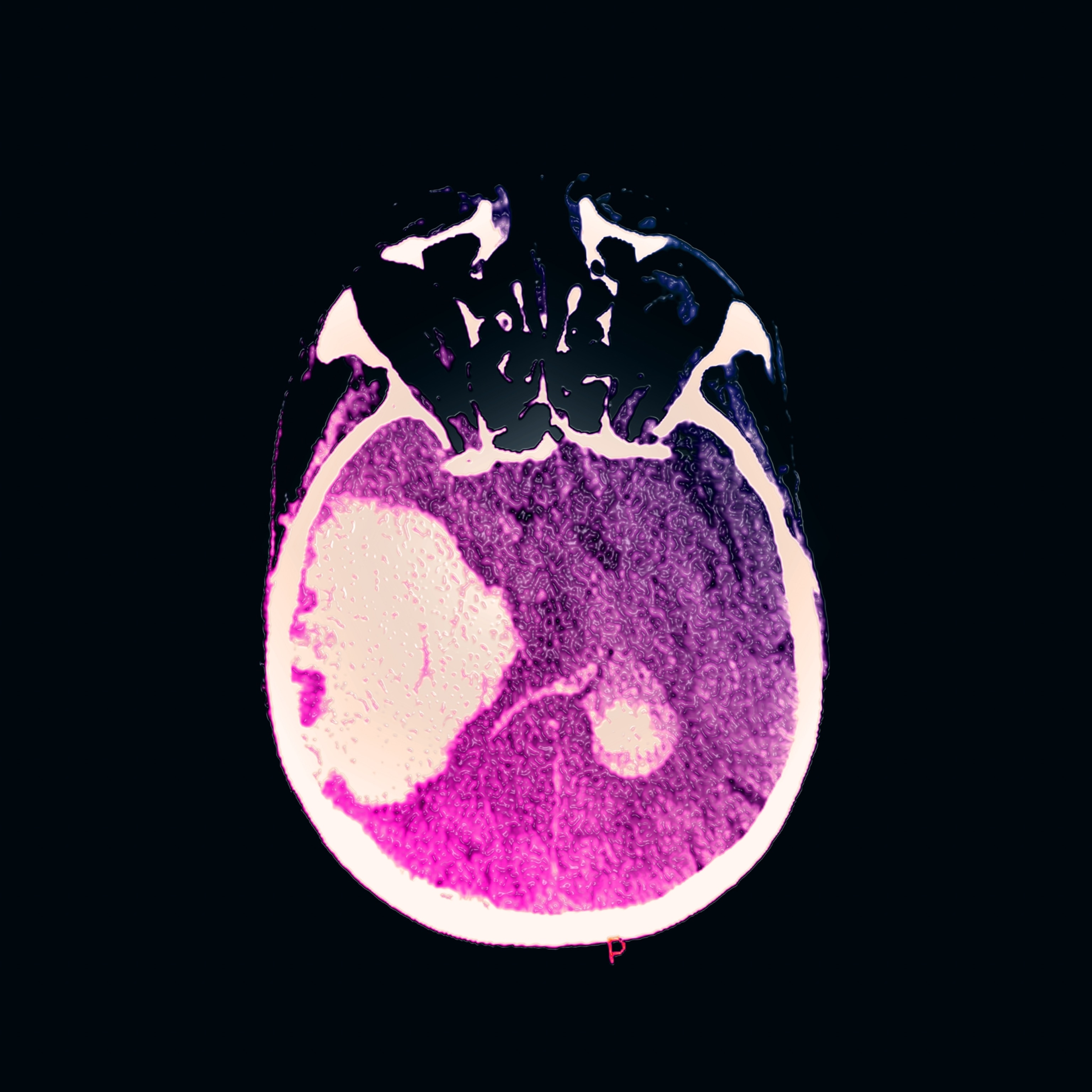 A cranial CT scan showing a large area of opacity indicative of bleeding within the skull