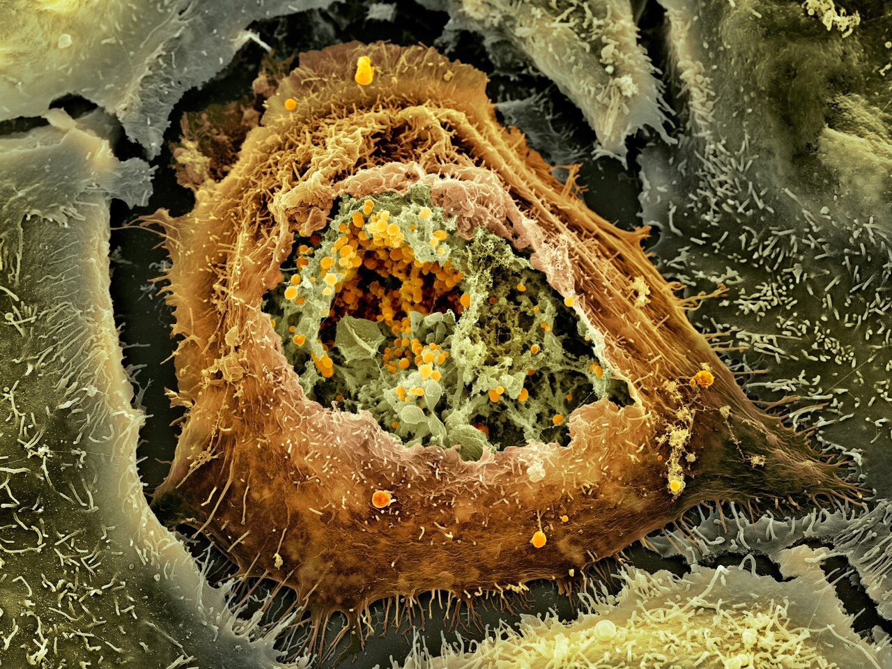 заболевание кариес бактерии