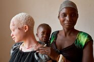 Albino Human