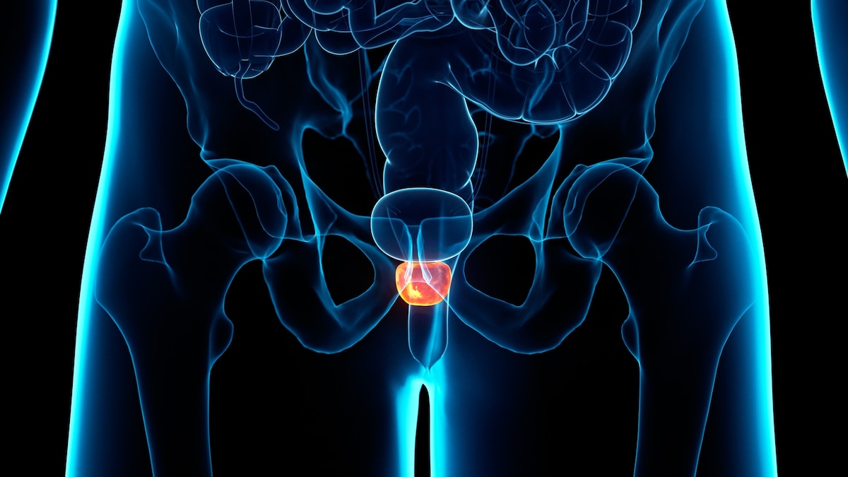 How breast cancer research is helping prostate cancer patients