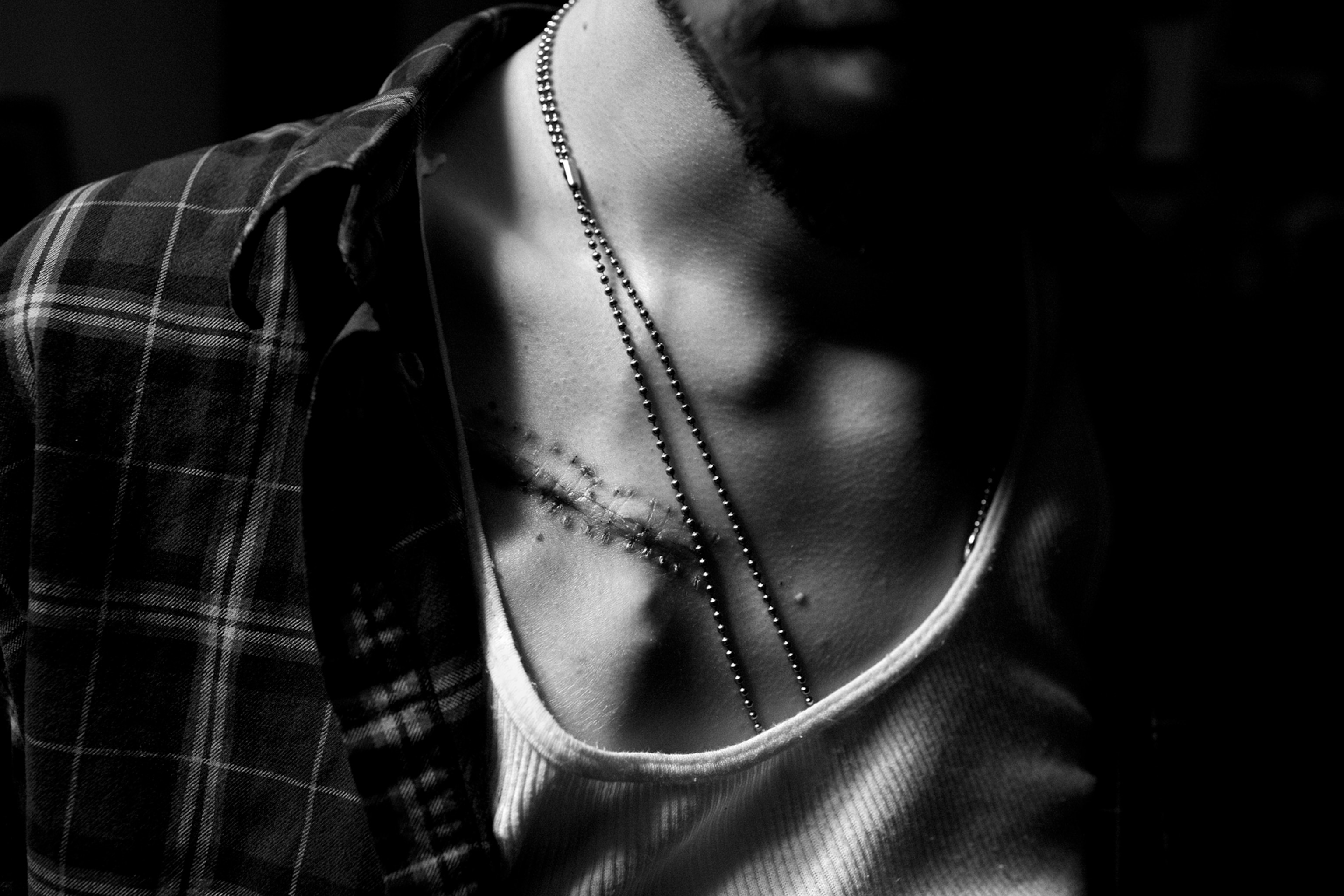 a scar from one of Nick's surgeries