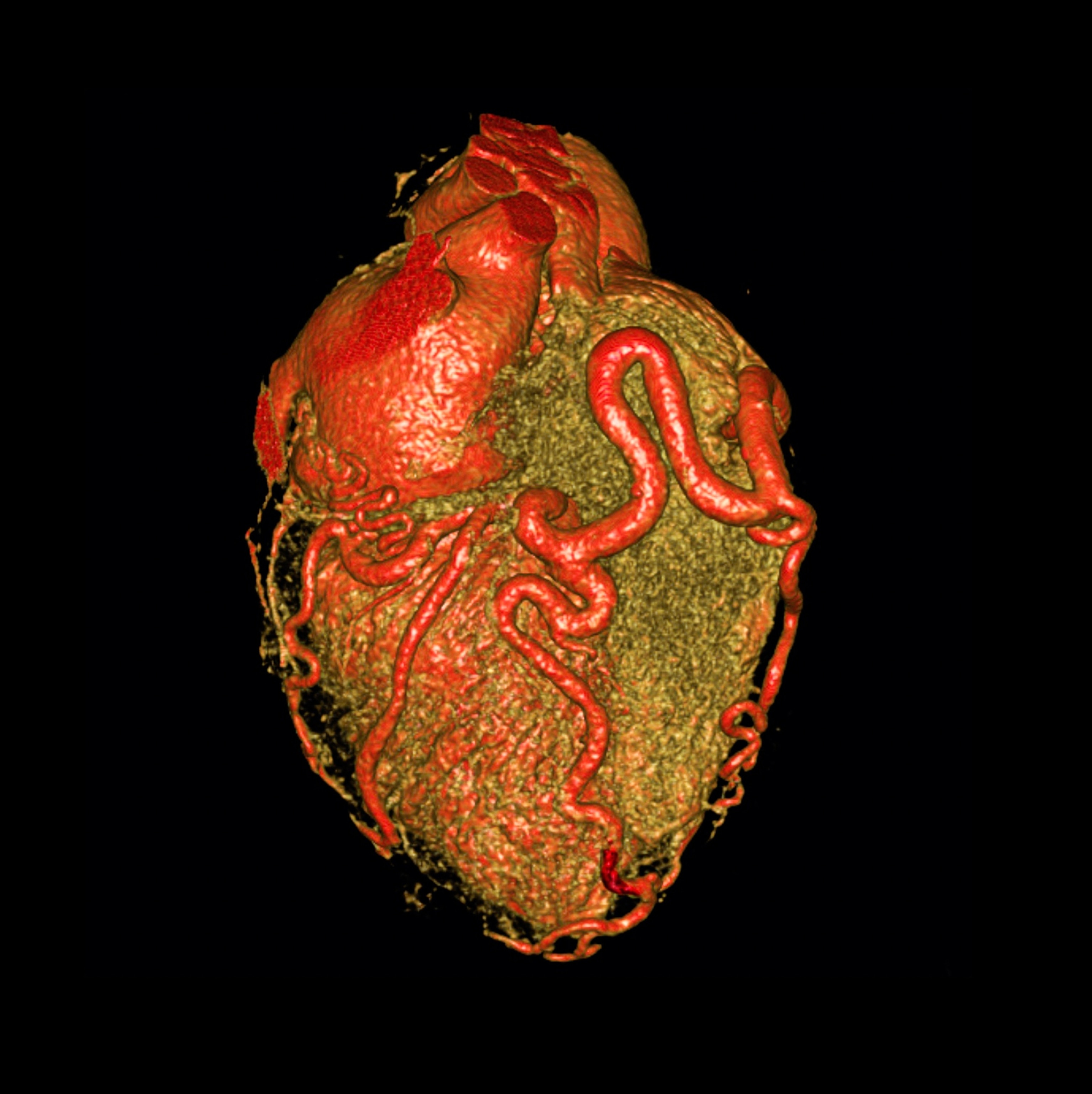 3D CT scan of a human heart highlighting red arteries, set against a black background