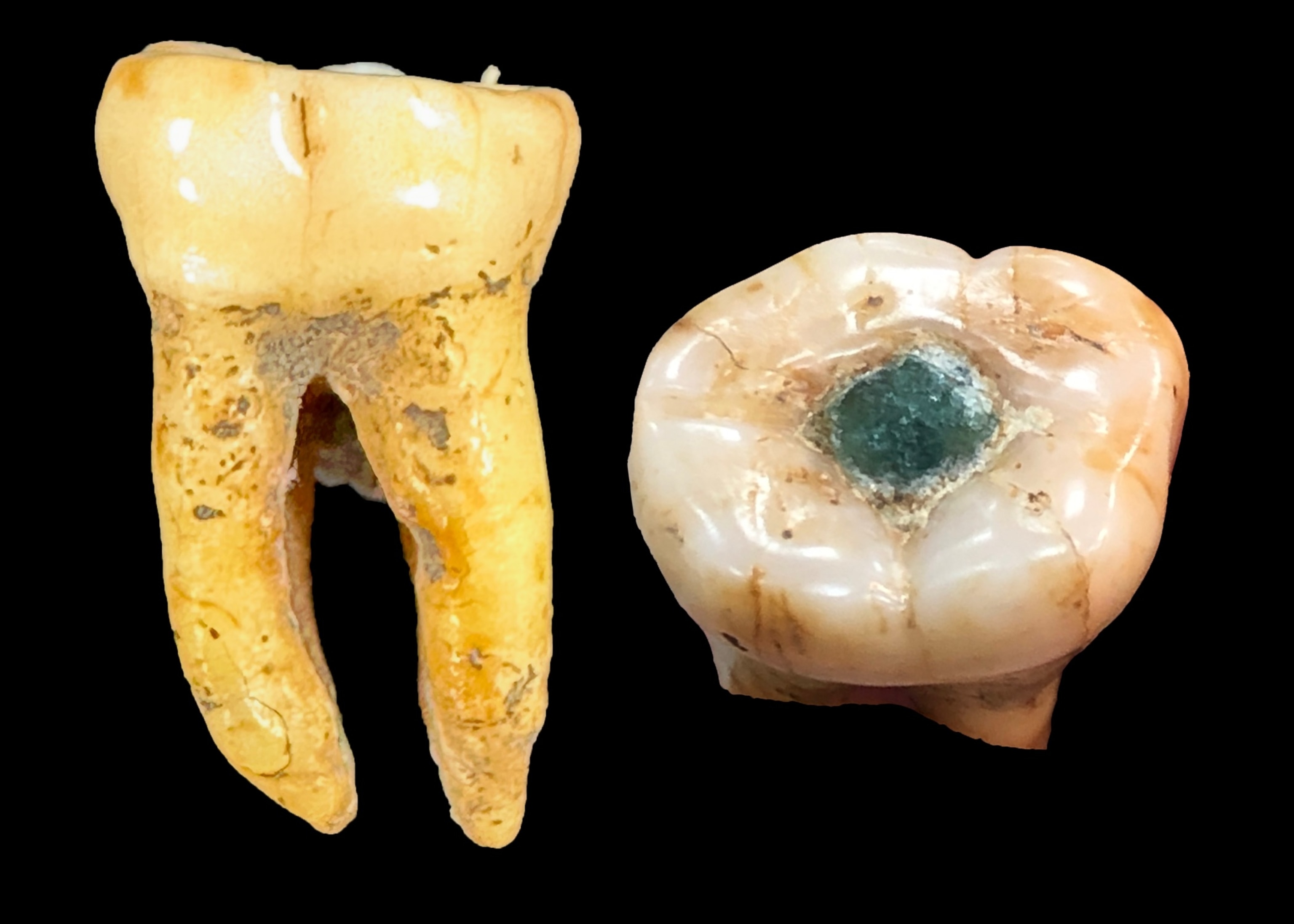 Two angles of a molar containing a jade stone on a black background