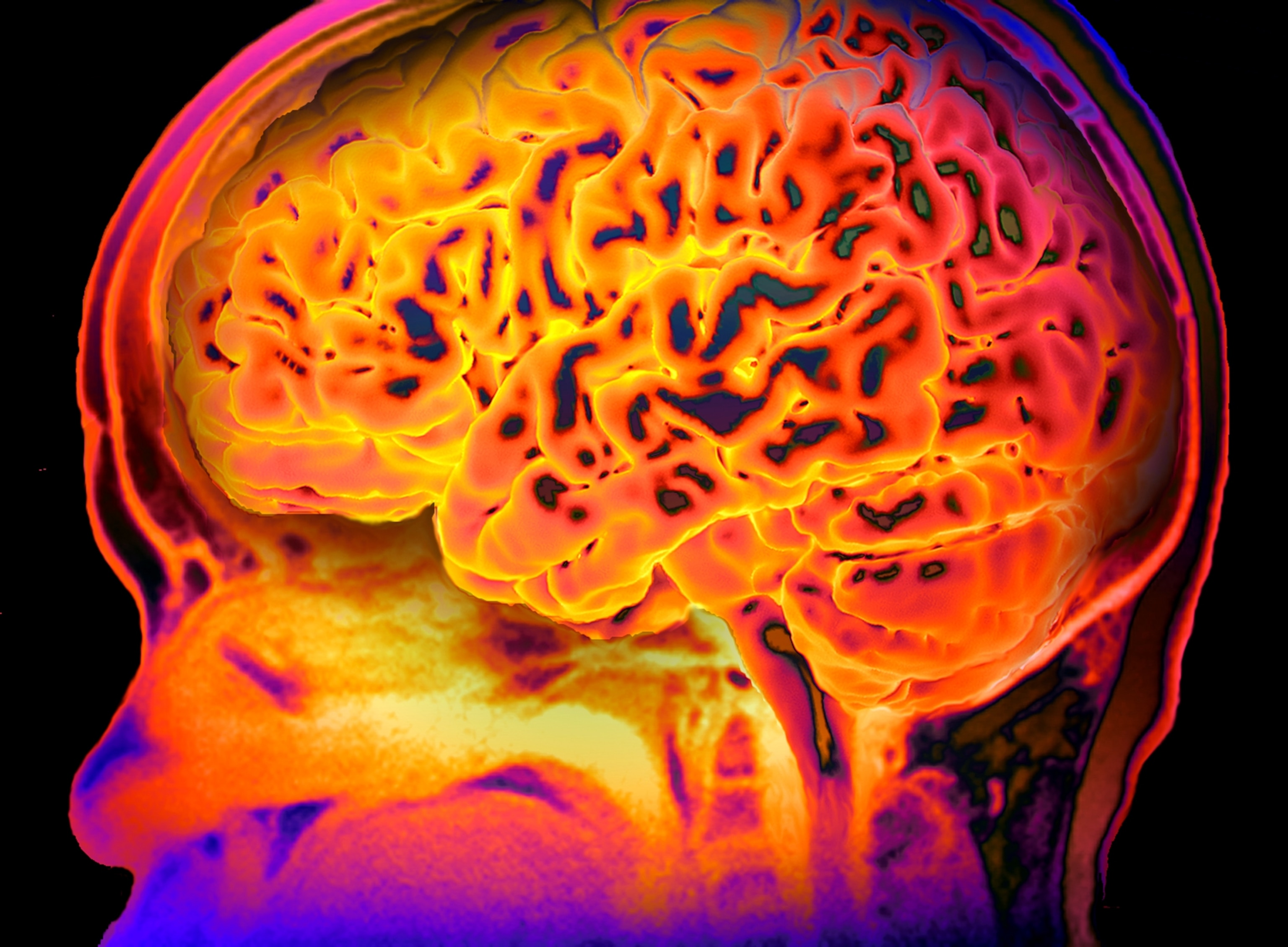 A bright and colorful MRI brain scan, revealing the ridges and grooves of the brain