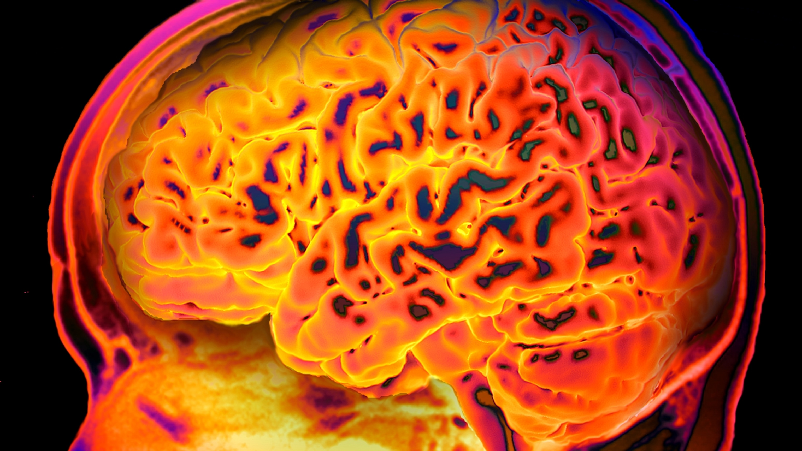 There might be 3 different types of ADHD, new brain study suggests
