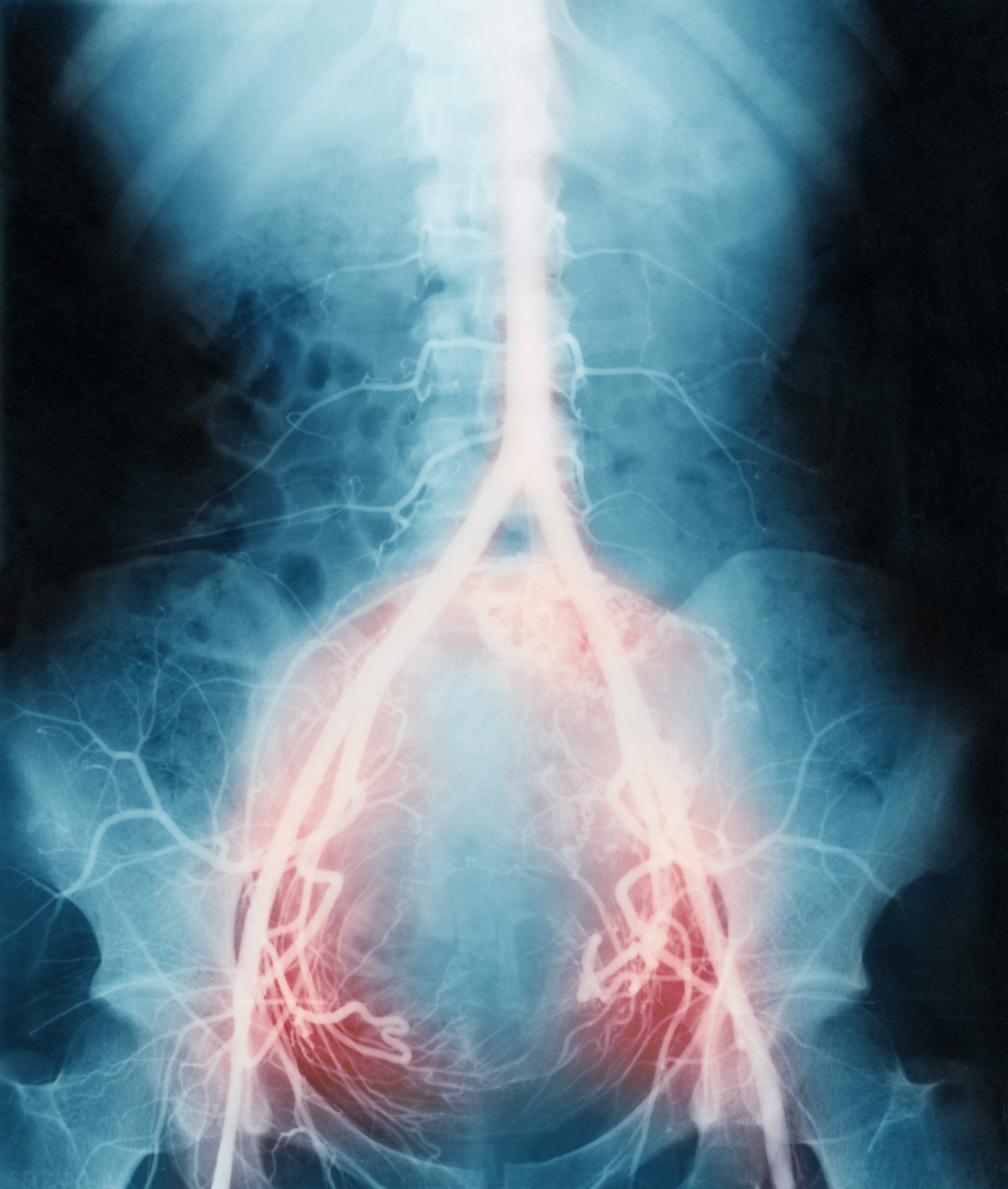 An abdominal angiogram X-ray showing highlighted red areas indicating blood flow in the pelvic region