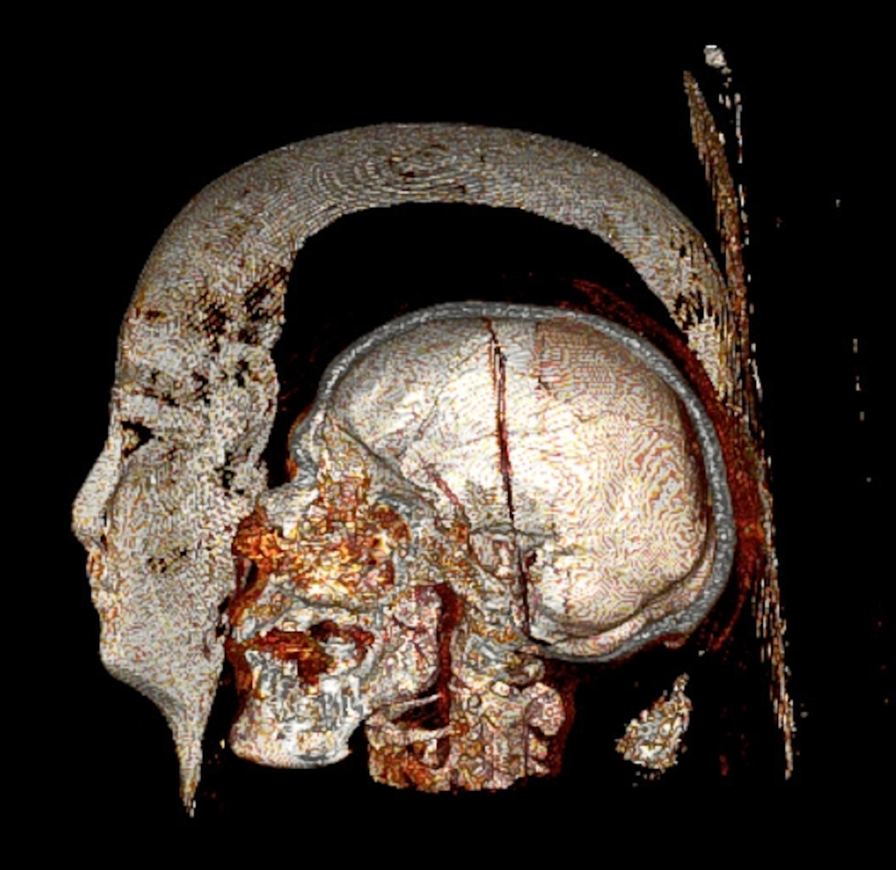Egyptian mummy picture: CT scan image of a mummy's skull inside a funerary mask