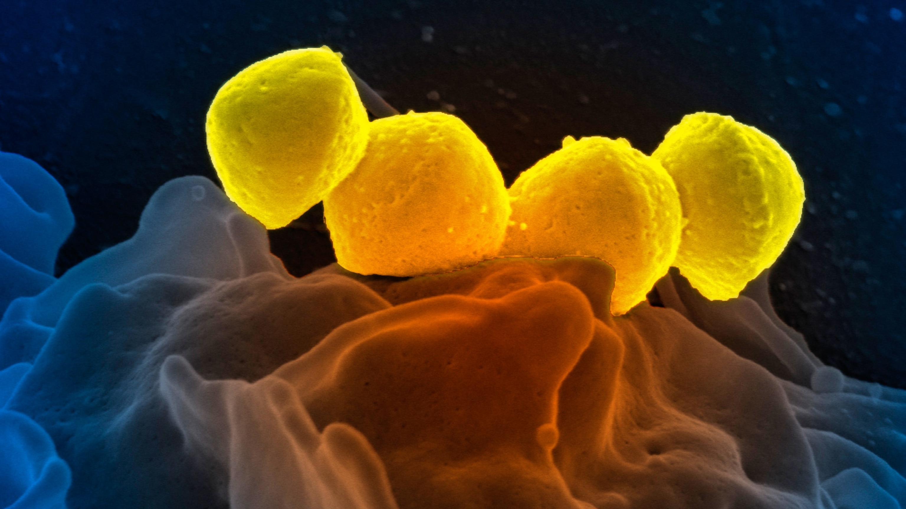 How strep throat may trigger autoimmune disease