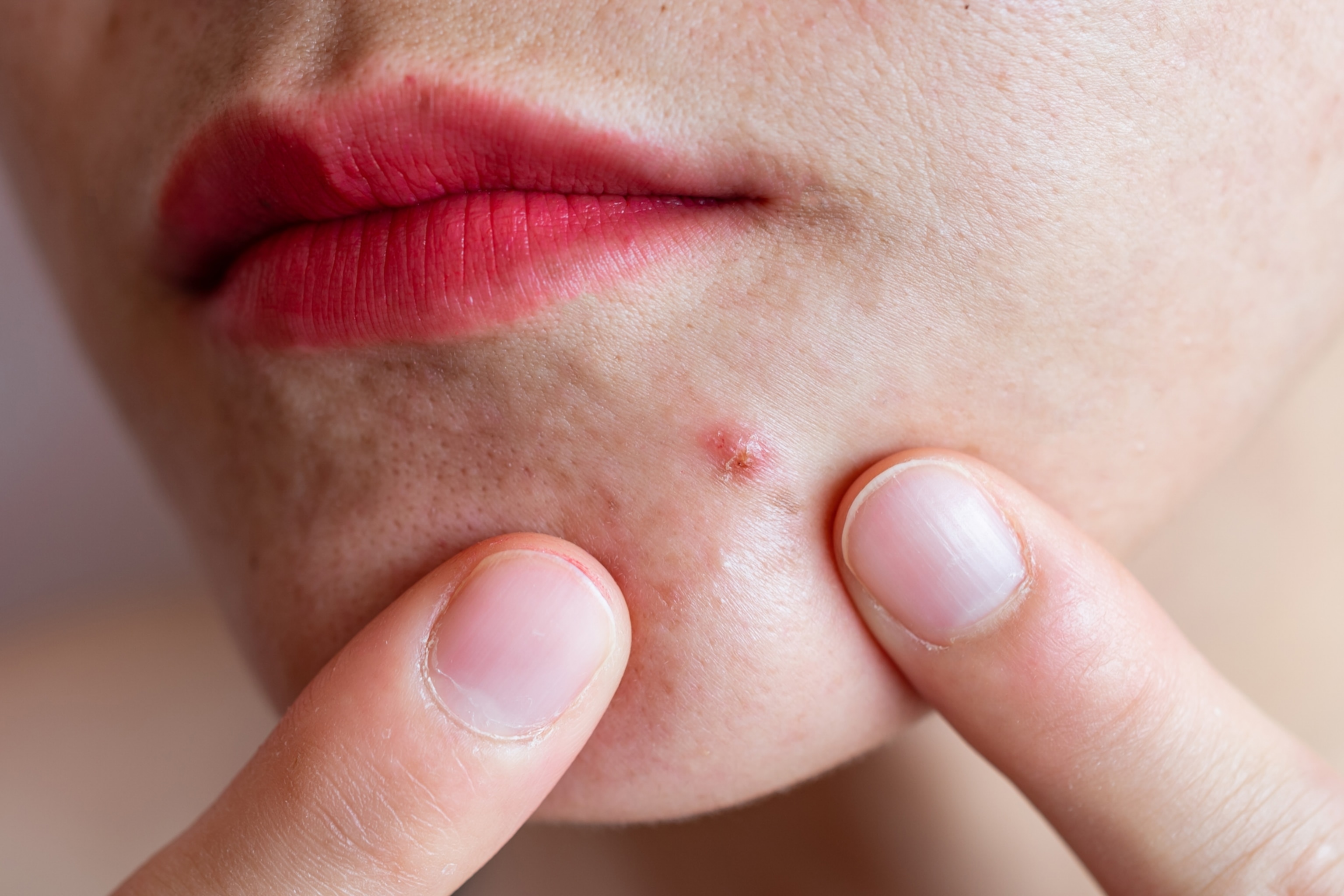 Close-up of a person's chin and lips, showing a pimple being squeezed by fingers