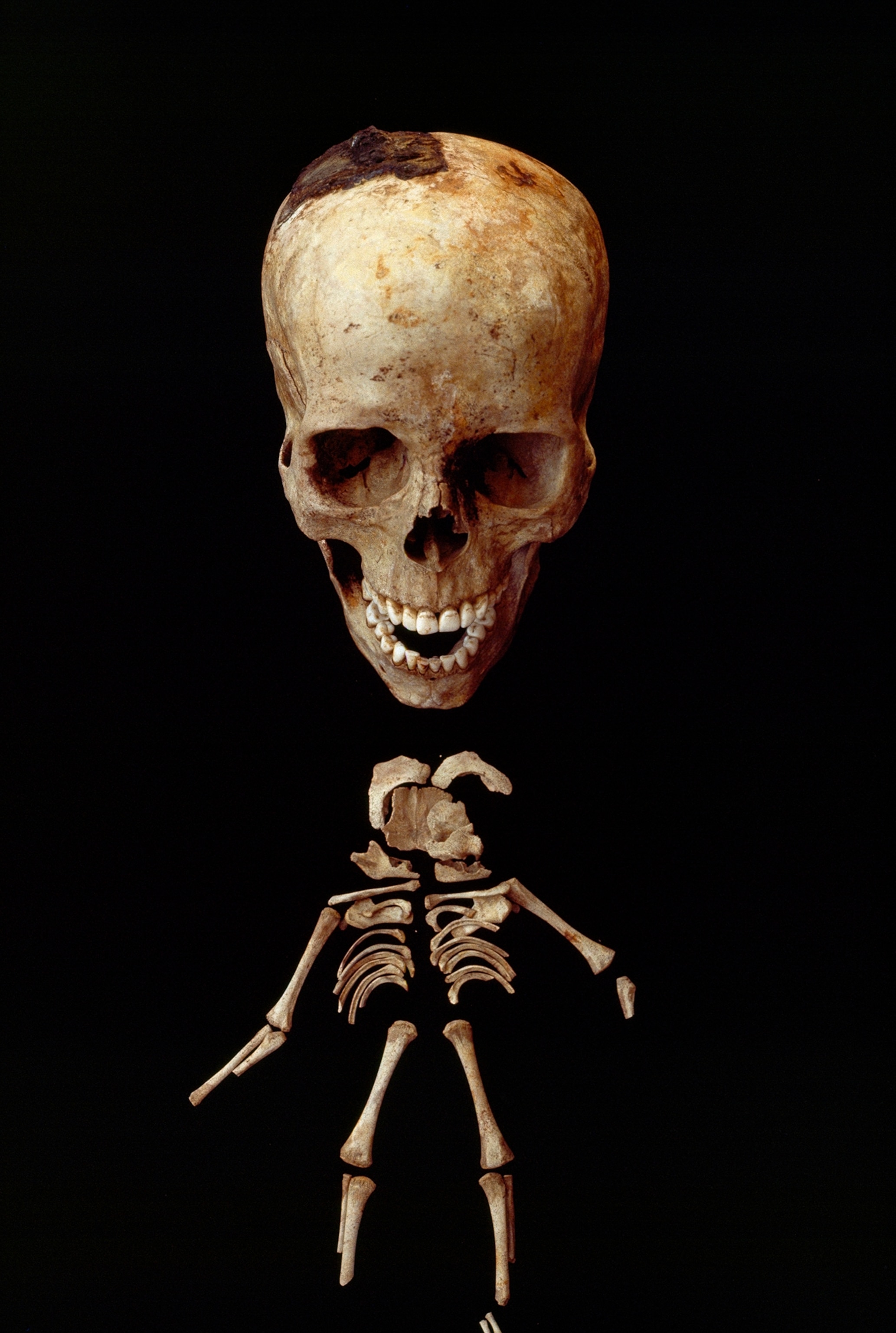 Remains of a pregnant woman and fetus killed by Mount Vesuvius' ash.