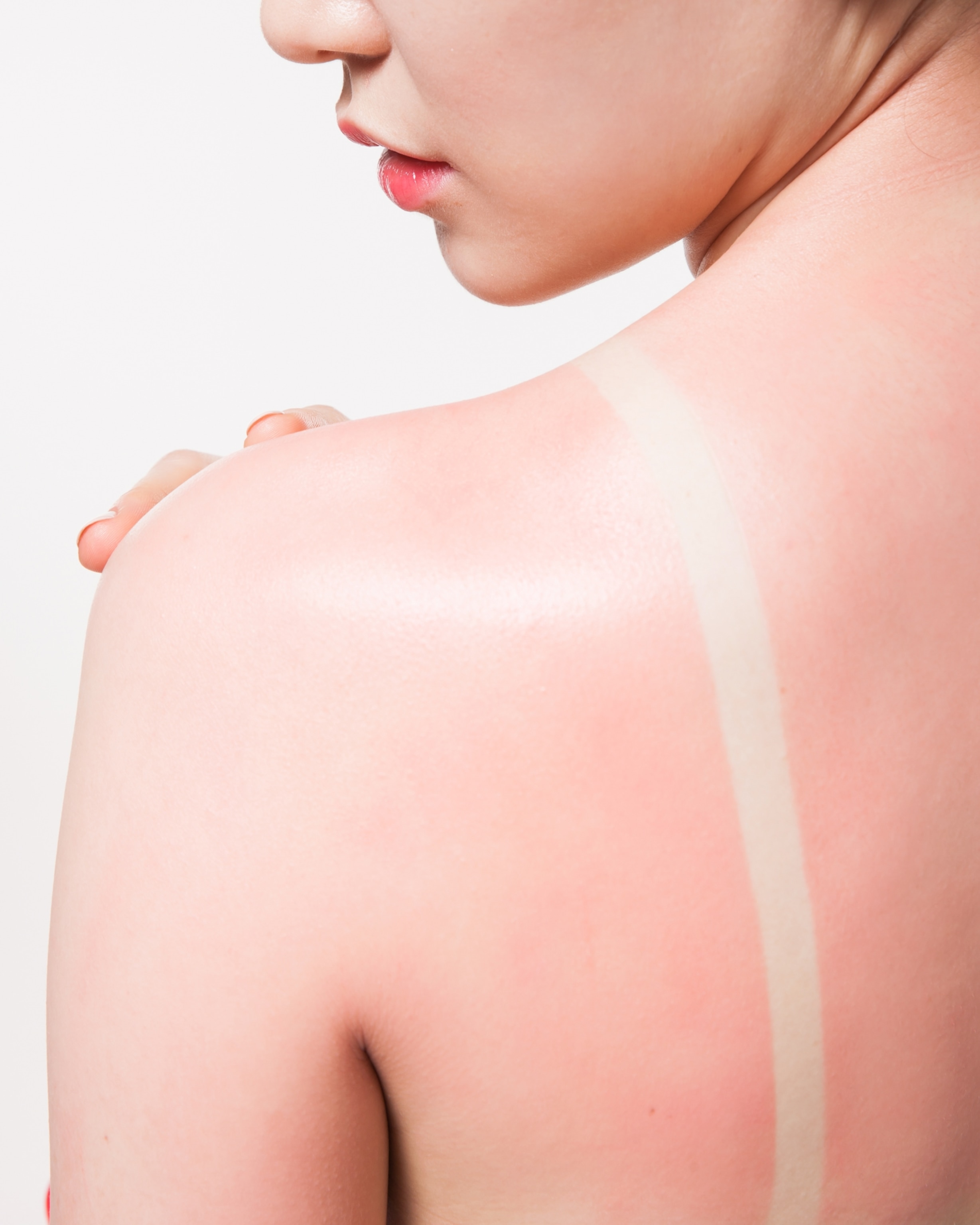 The back of a woman's shoulder, where there is a visible strap tan-line crossing pink, sun-burnt skin