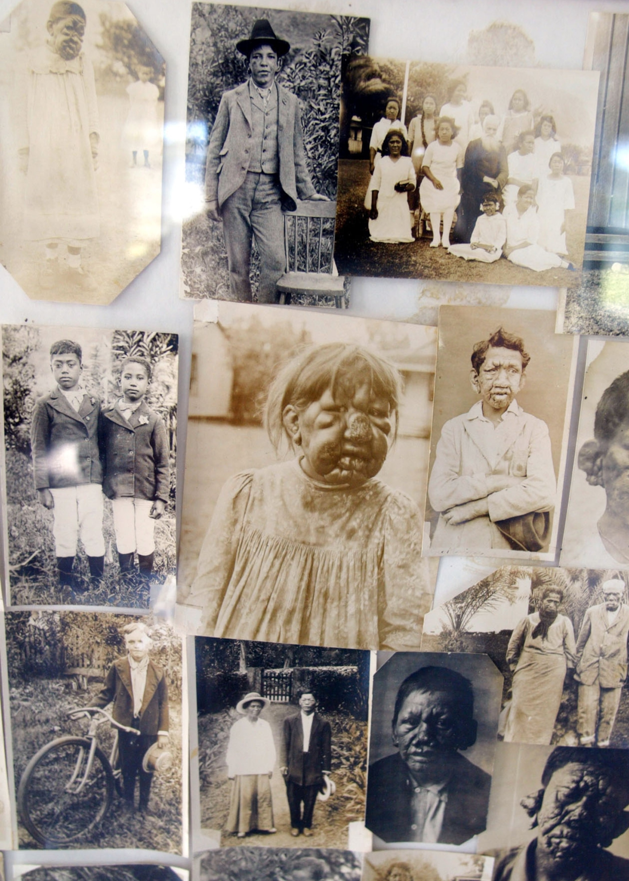 Photographs of patients disfigured by Hansen's disease, also called leprosy, are on display at a memorial hall in Kalaupapa, Hawaii Jan. 22, 2003. Kalaupapa was once a sprawling and lively community with a population of more than 1,000. Now graves of outnumber patients nearly 200 to 1.
