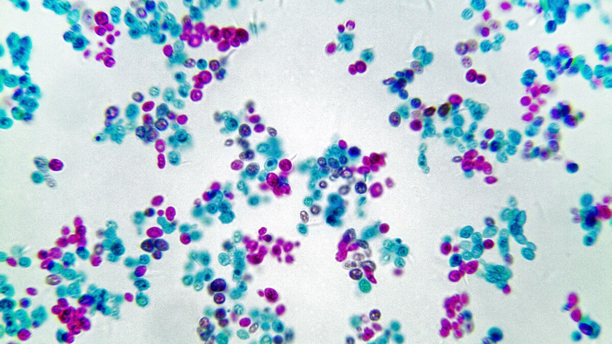 New and Deadly DrugResistant Yeast Emerges Globally