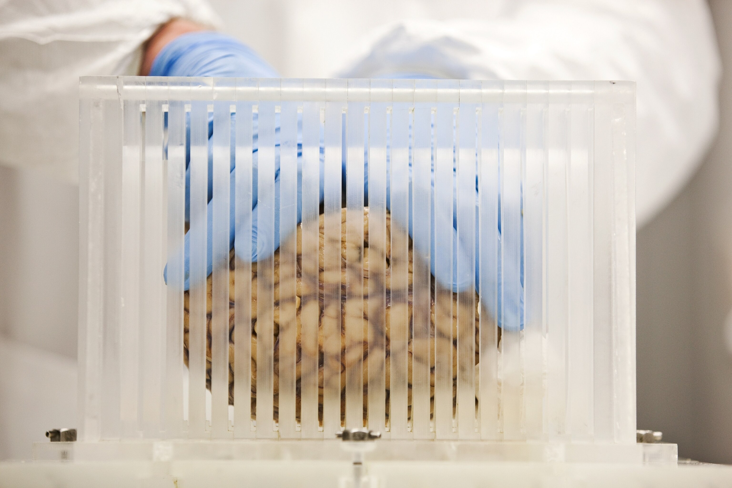 a woman with Alzheimer's siting on a swing shaded by an umbrella.