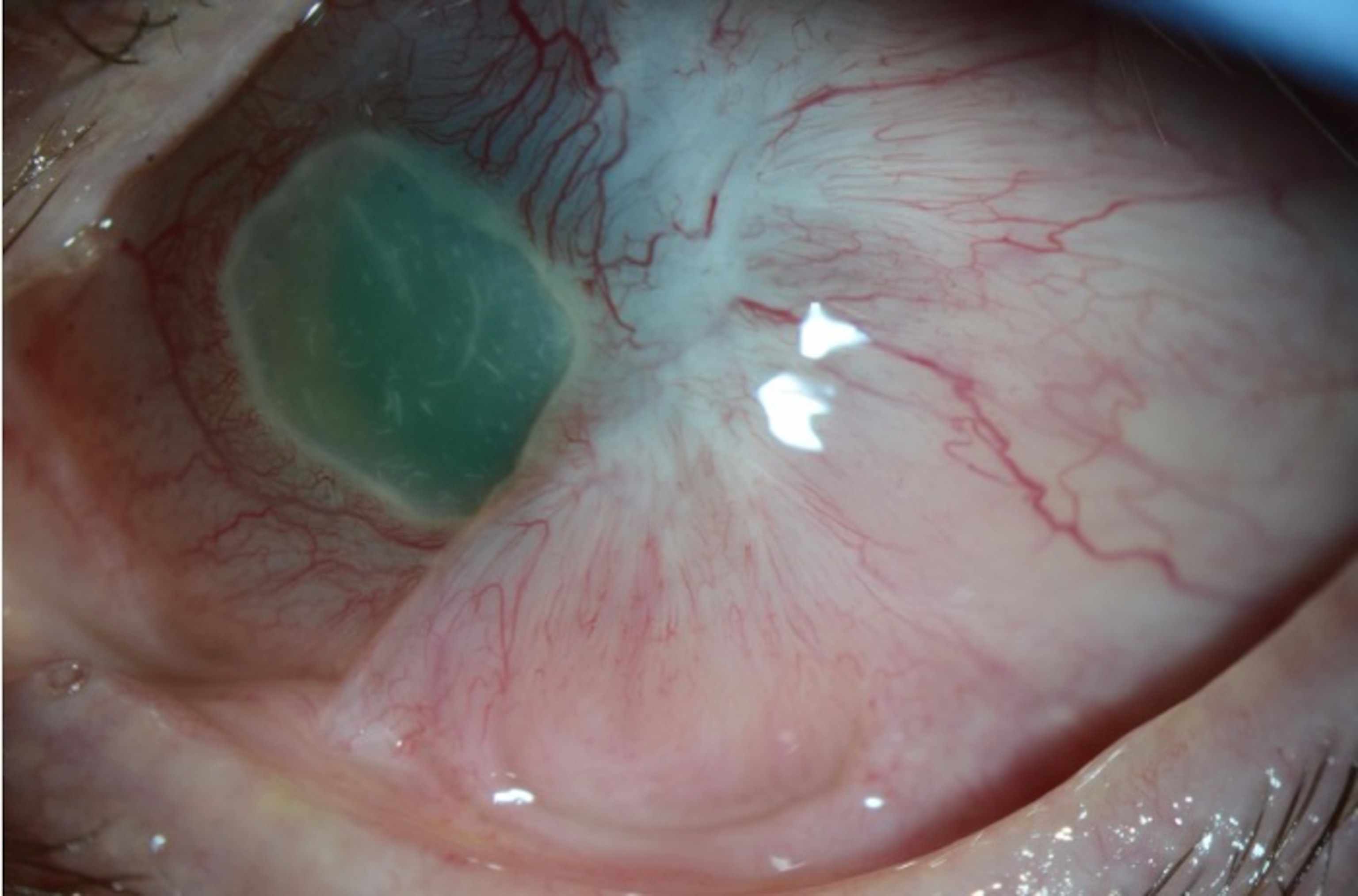Close-up of an eye showing a cloudy, greenish corneal opacity. The eye appears red and irritated, with visible blood vessels