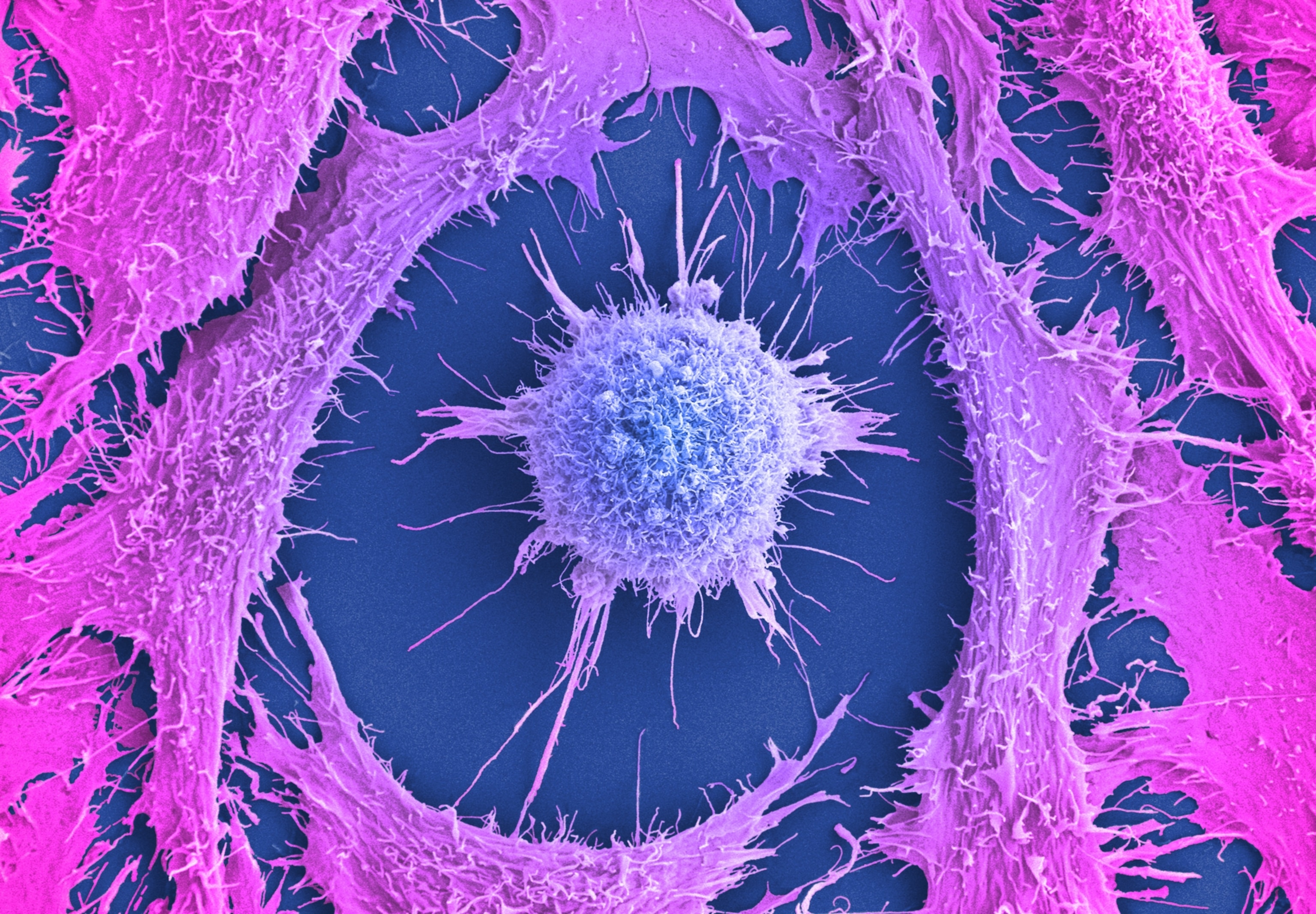 A highly magnified cancer cell is depicted, with a vibrant blue center and spreading pink, fibrous extensions