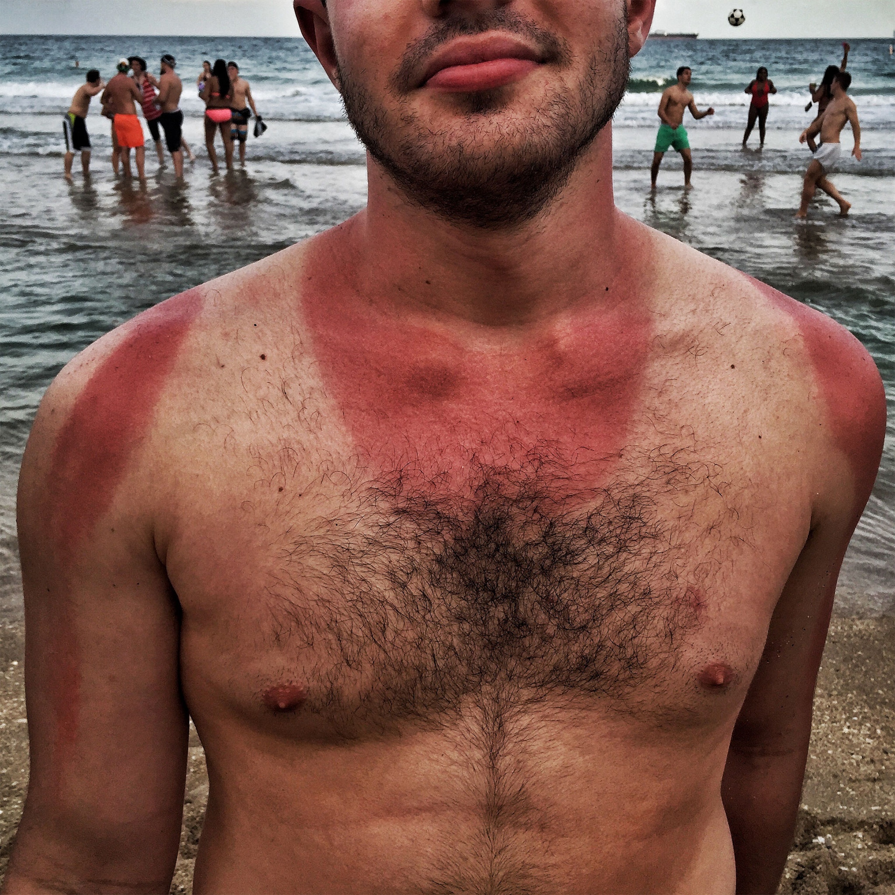 a man with sunburn
