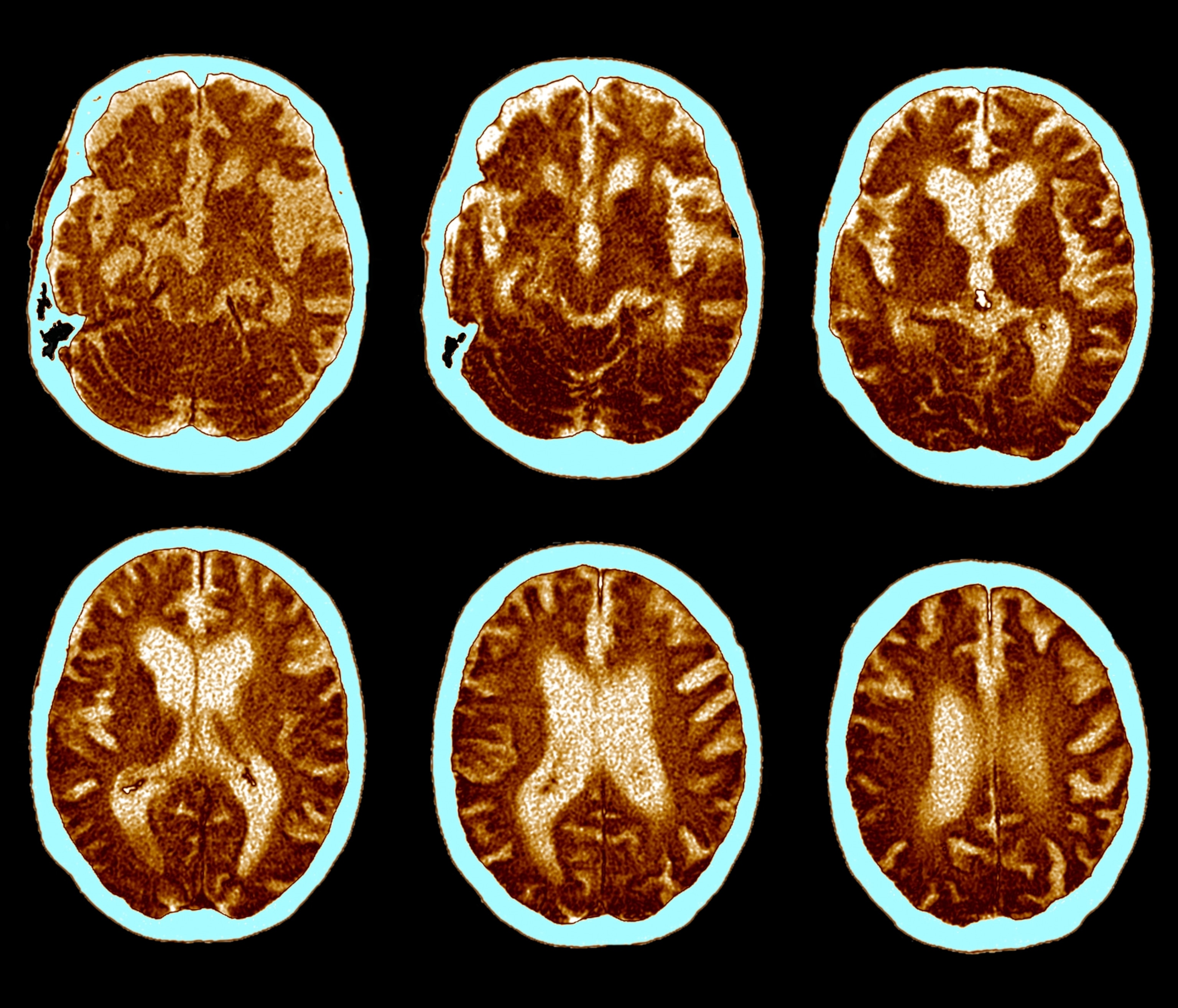 Six MRI brain scans in two rows show cross-sections with brown tones on a light blue background, highlighting brain structure and details.