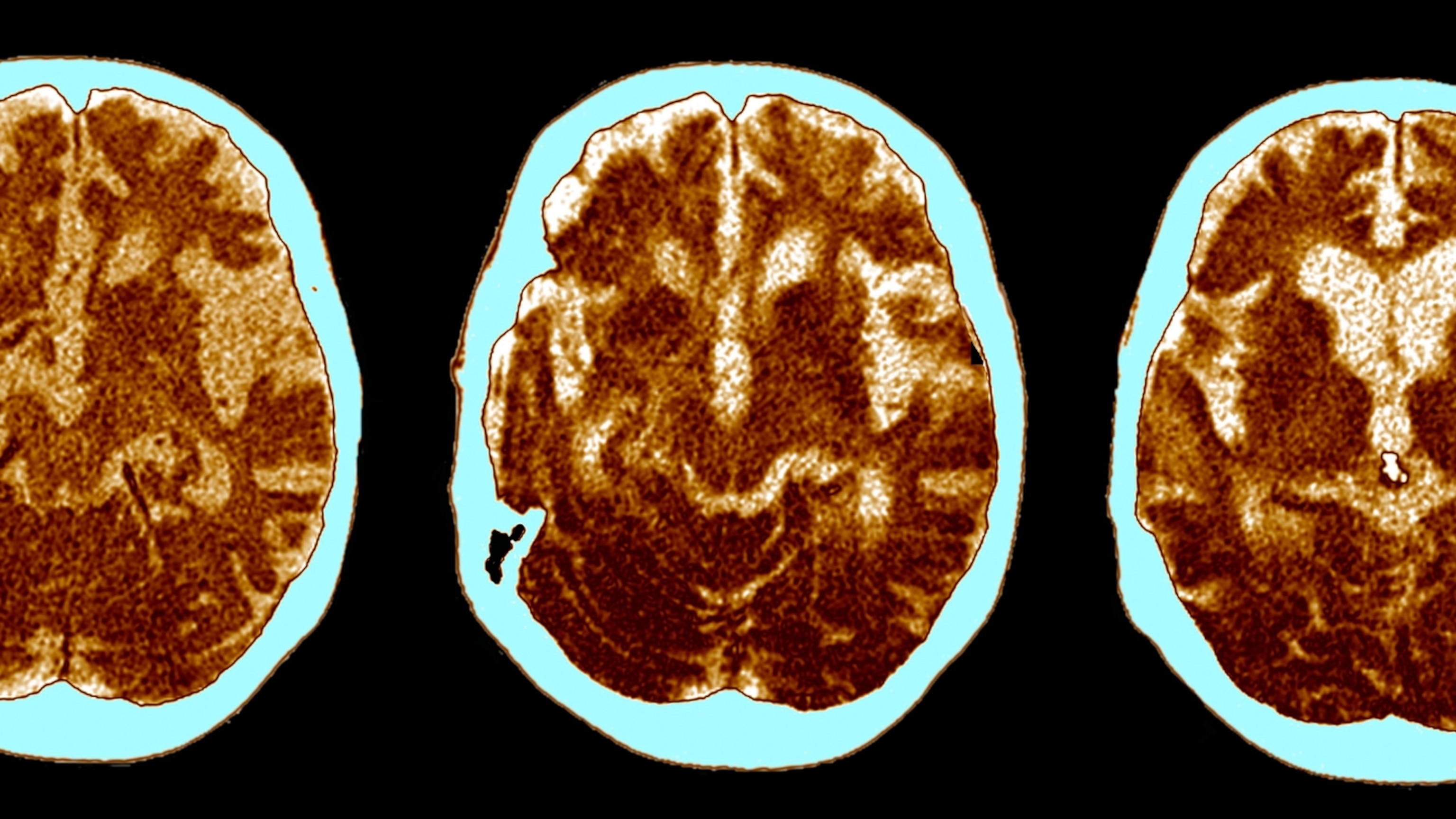 The curious link between Alzheimer’s disease and cancer