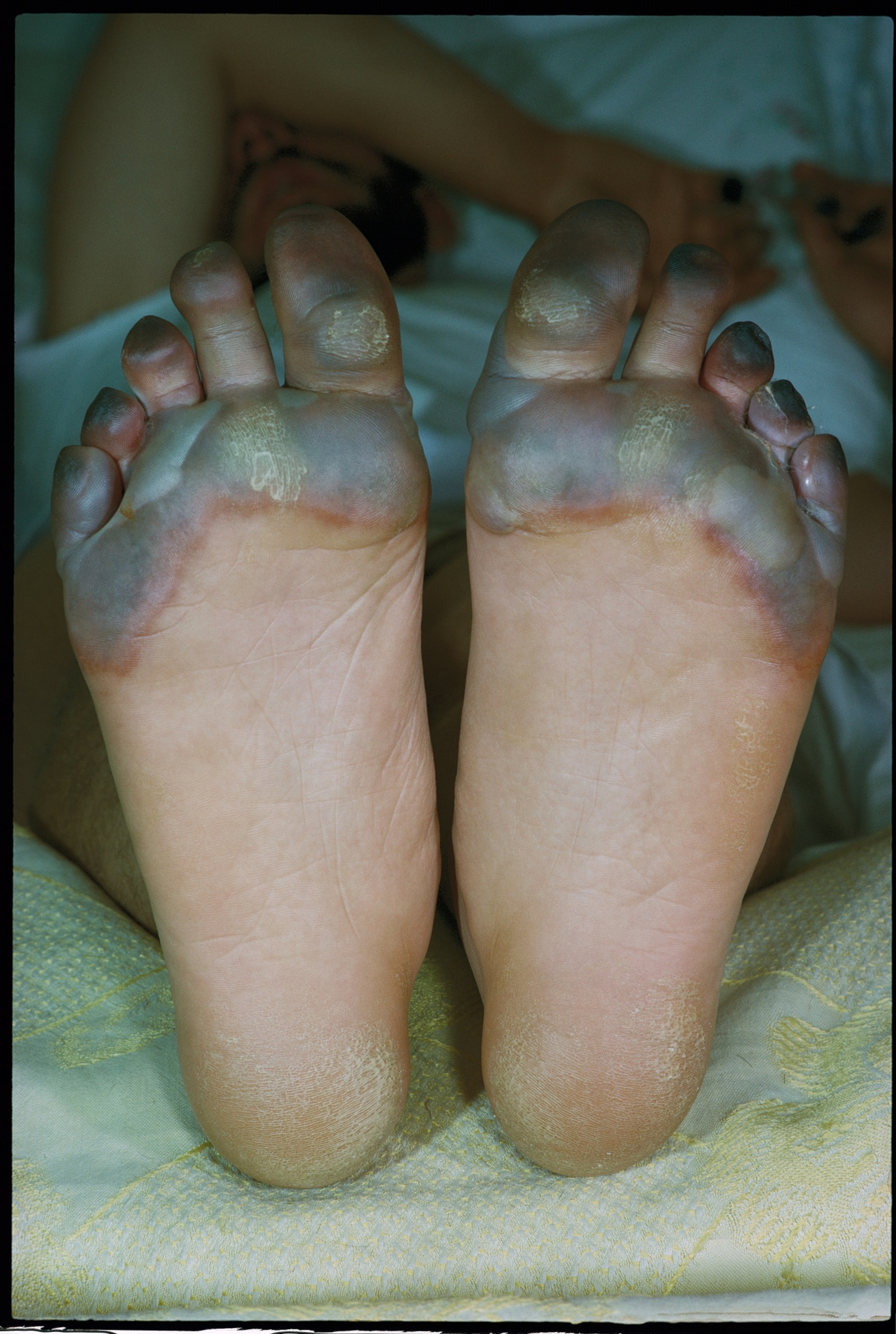 Blackened tips of the author’s frostbitten fingers and toes indicate gangrene, or tissue death. Dr. Eldred D. Mundth of the Naval Medical Research Institute in Bethesda, Maryland, flew to Kathmandu to give the men injections of an experimental drug to improve the flow of blood to injured tissues. Later, both Bishop and Unsoeld lost toes; Bishop also lost parts of the little fingers of each hand.