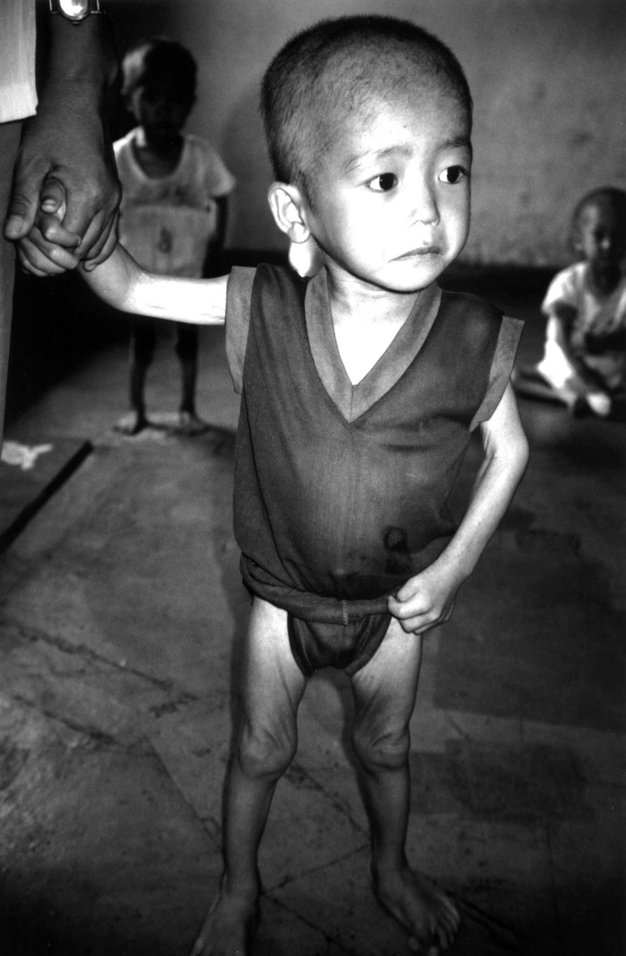 a malnourished child in north korea