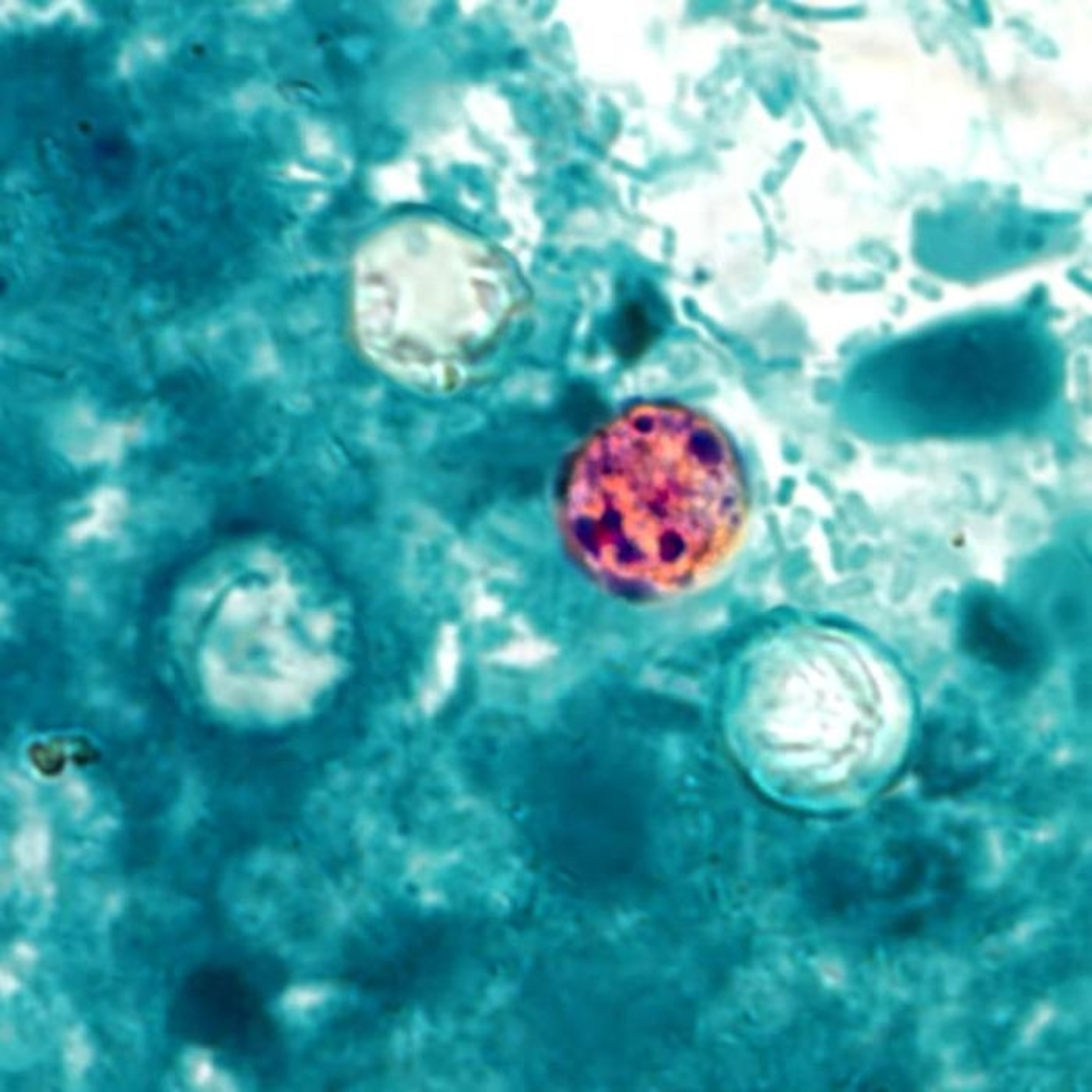 Photomicrograph of a fresh stool sample with a presence of four Cyclospora cayetanensis, photo has a blue background and three clear circular shapes, and one pink circular shape.