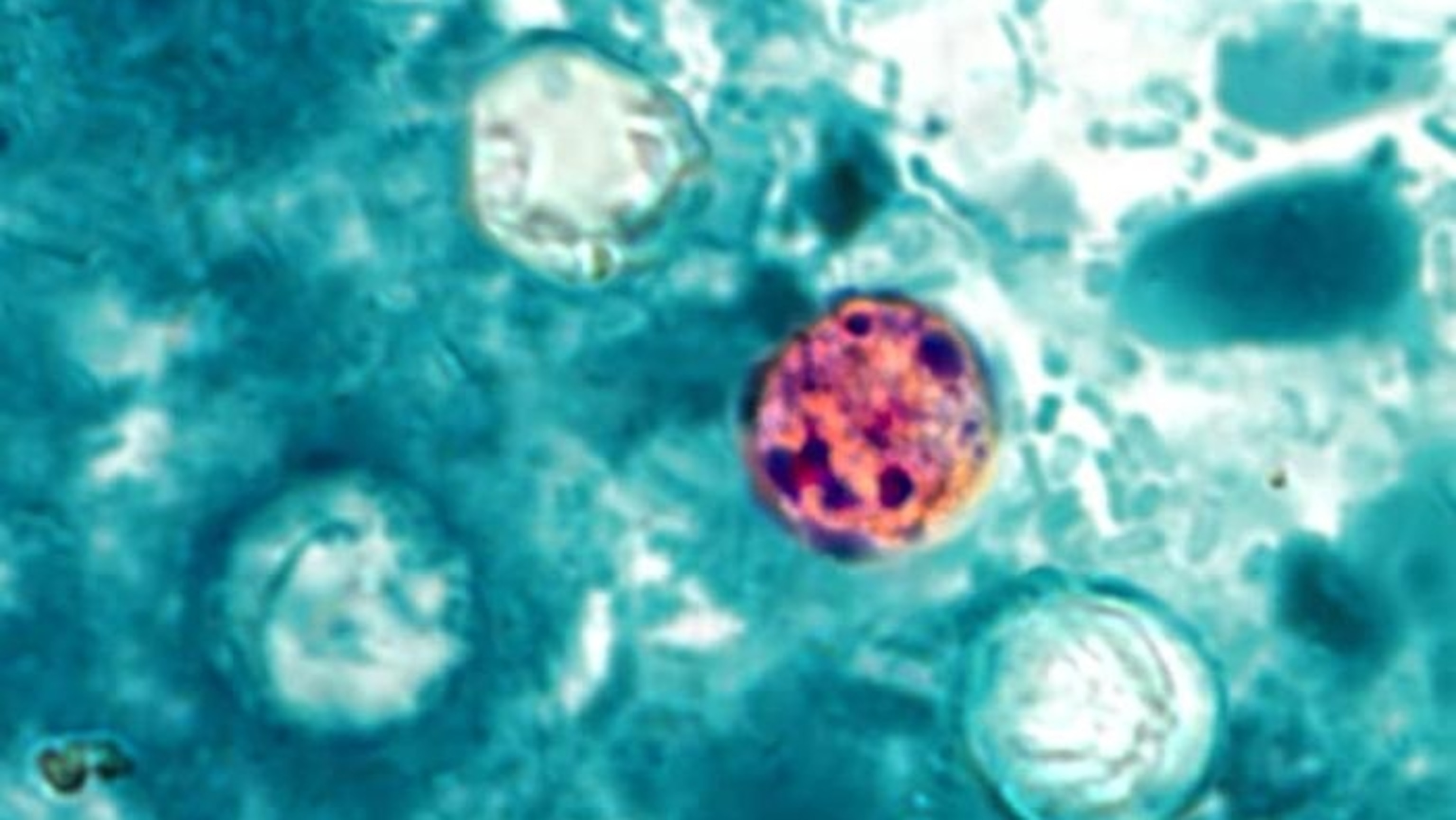 What is cyclospora? Here’s how the parasite spreads