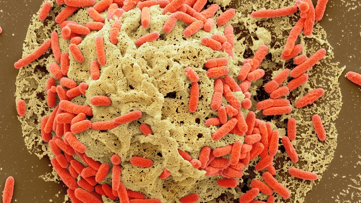 Colon cancer is rising in young people and scientists got a clue about why