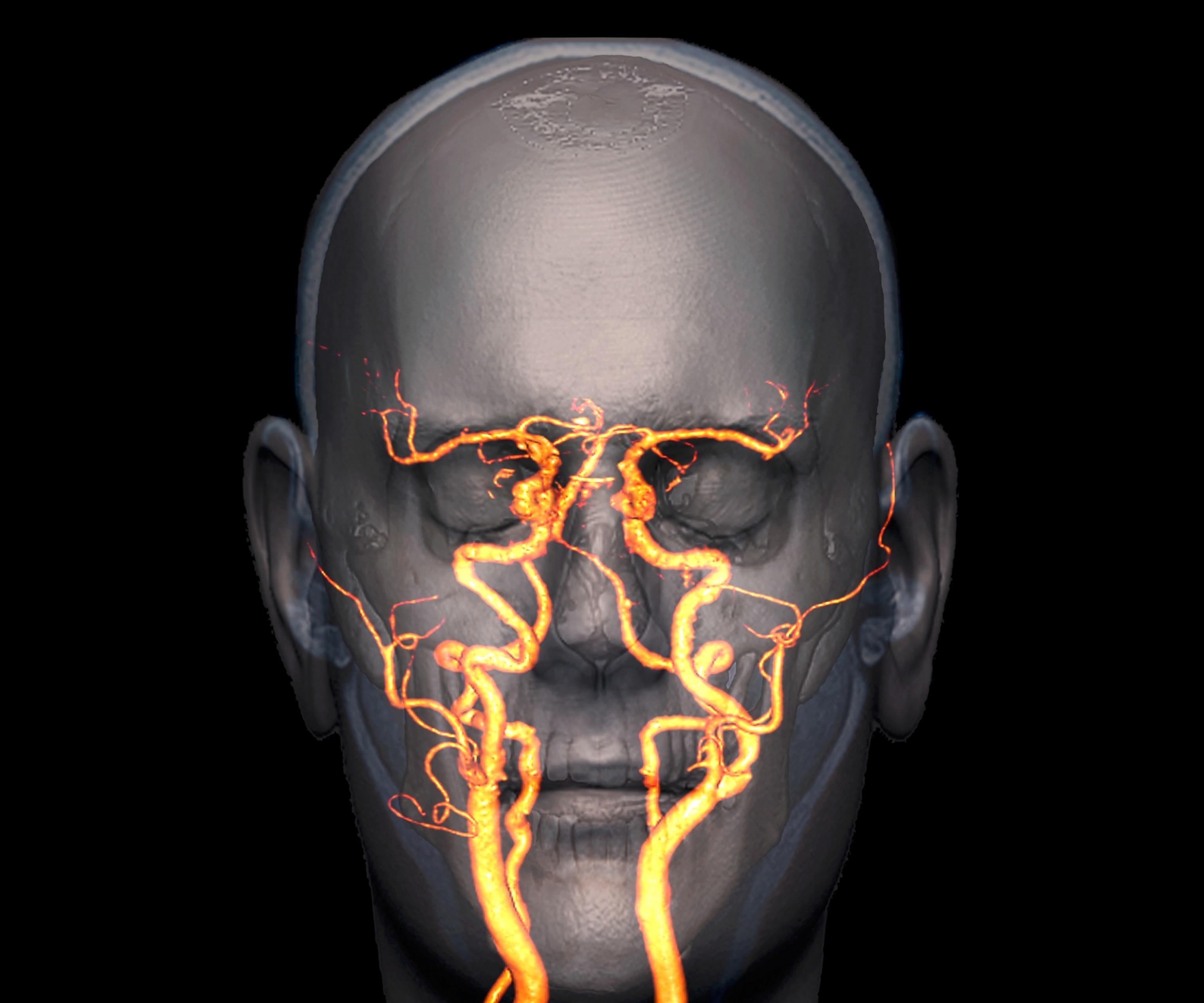 A head with blood vessels superimposed. Some of the blood vessels show signs of narrowing.