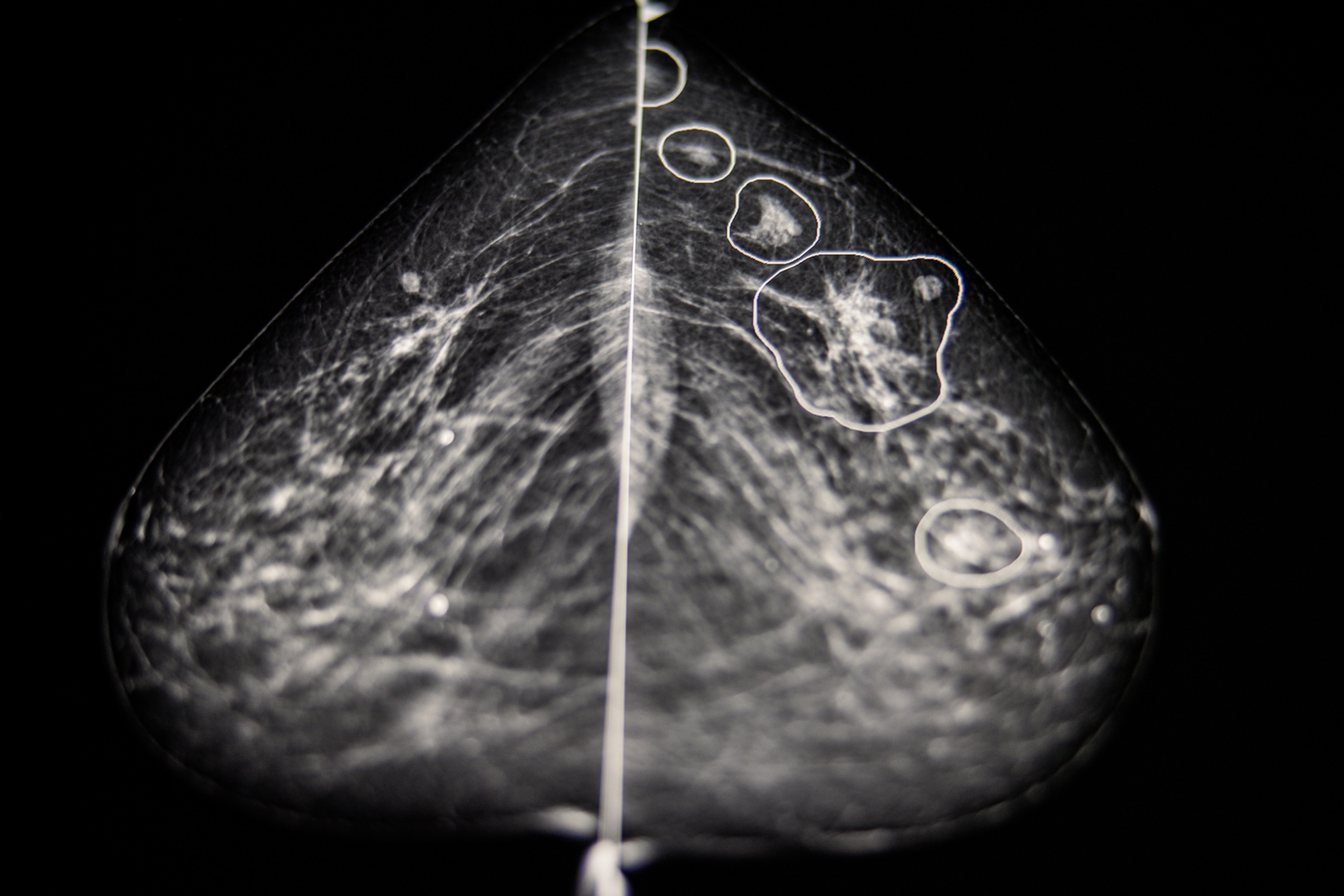 Possible anomalies in a breast cancer screen are highlighted by an AI software
