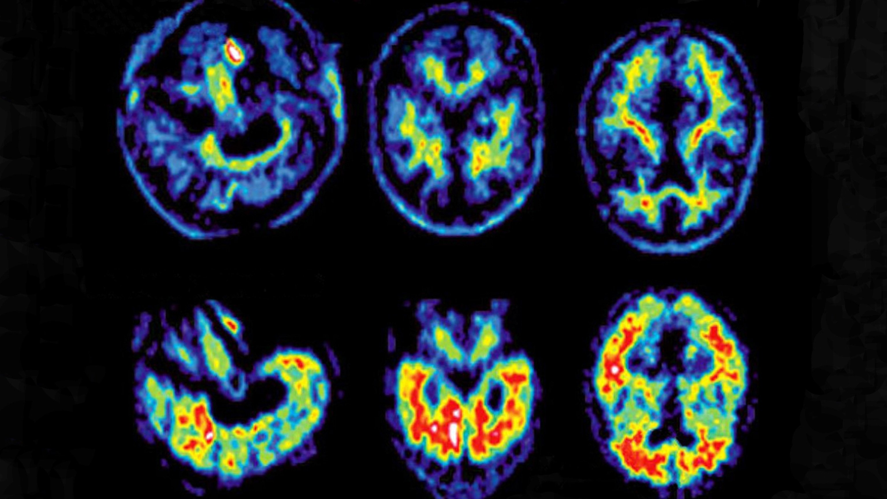 Why the new Alzheimer’s drug is eliciting both optimism and caution