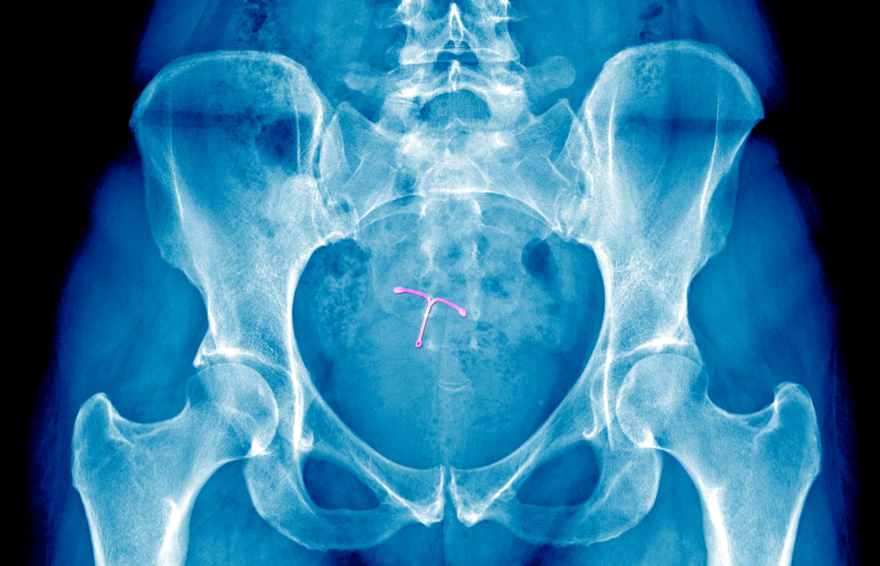 An x-ray of a pelvis showing an intrauterine device, highlighted in pink
