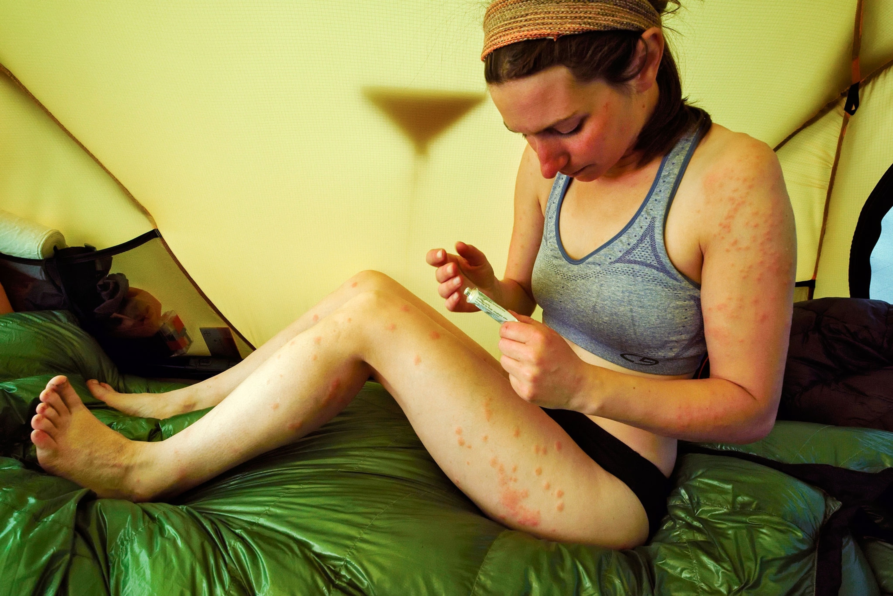 a woman putting ointment on hundreds of mosquito bites