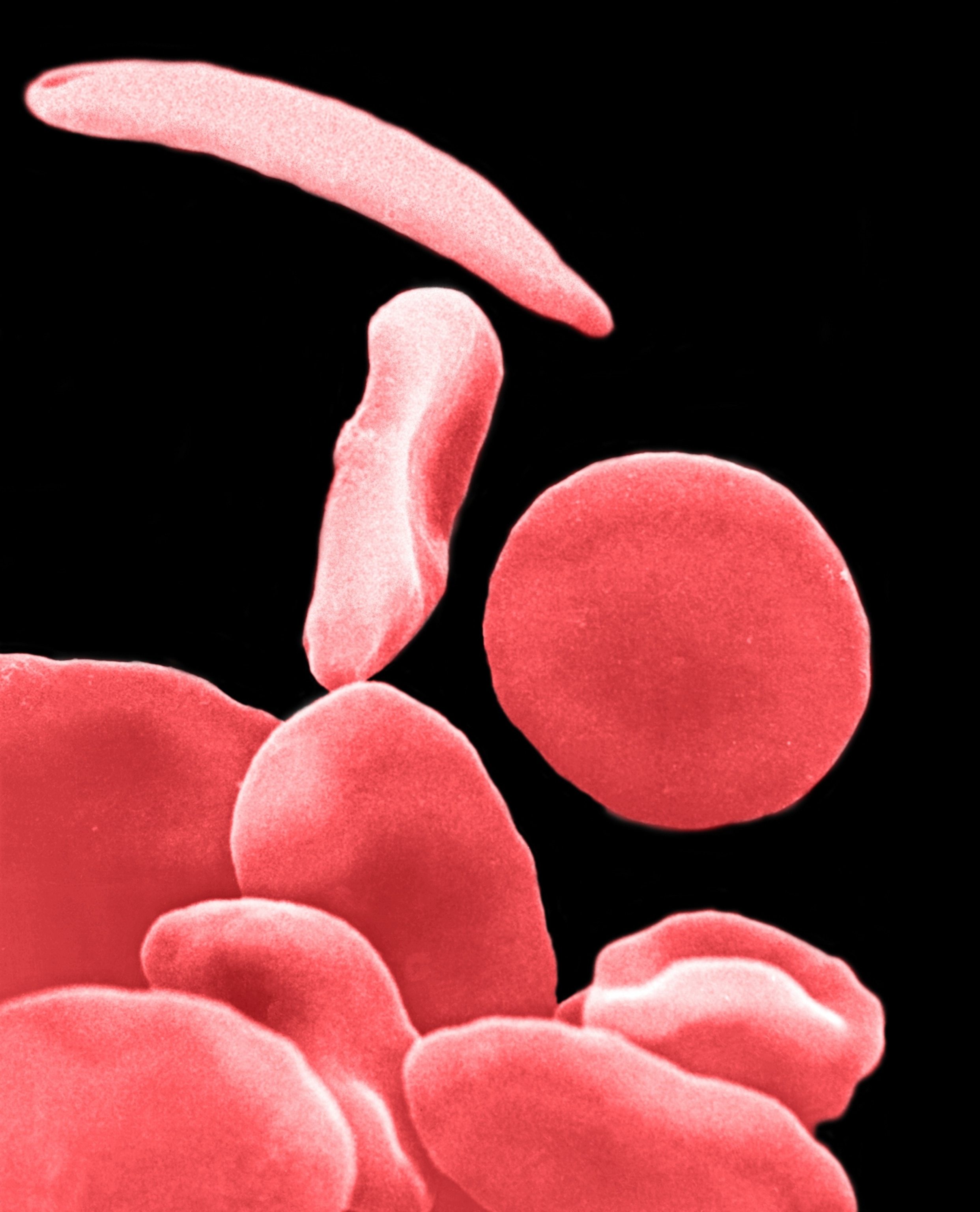 Microscopic view of red blood cells: healthy round cells mixed with irregular, sickle-shaped ones, against a black background.