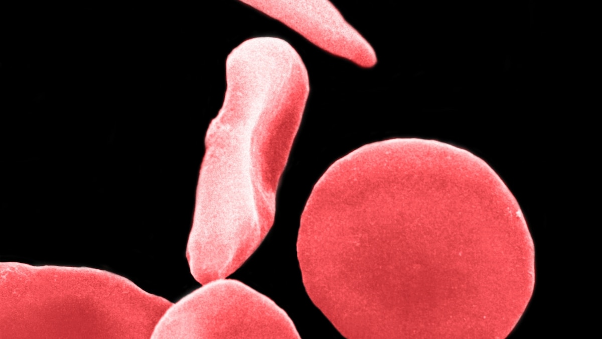 Scientists cured sickle cell. Then their next challenge began.